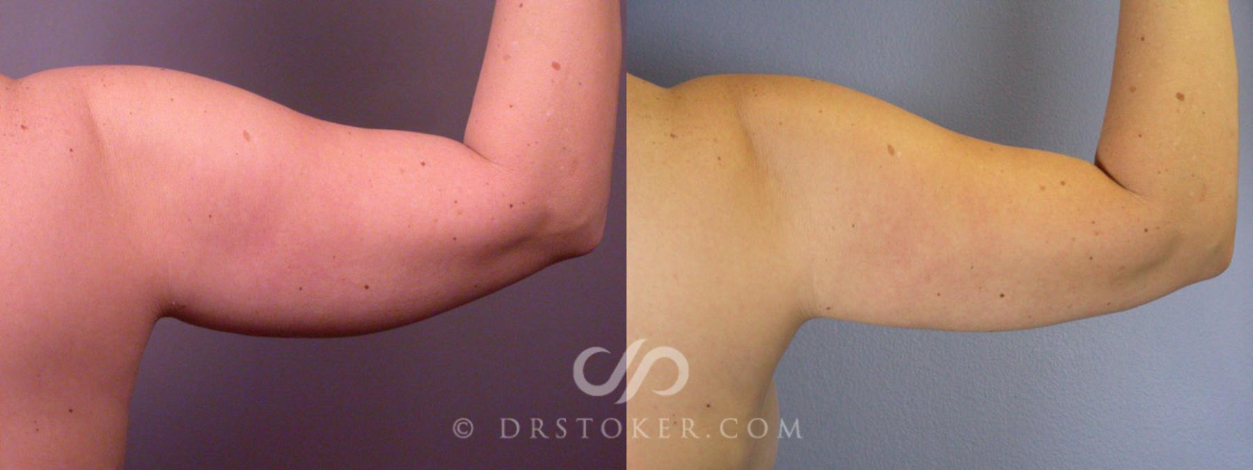 Before & After Liposuction Case 160 View #12 View in Los Angeles, CA