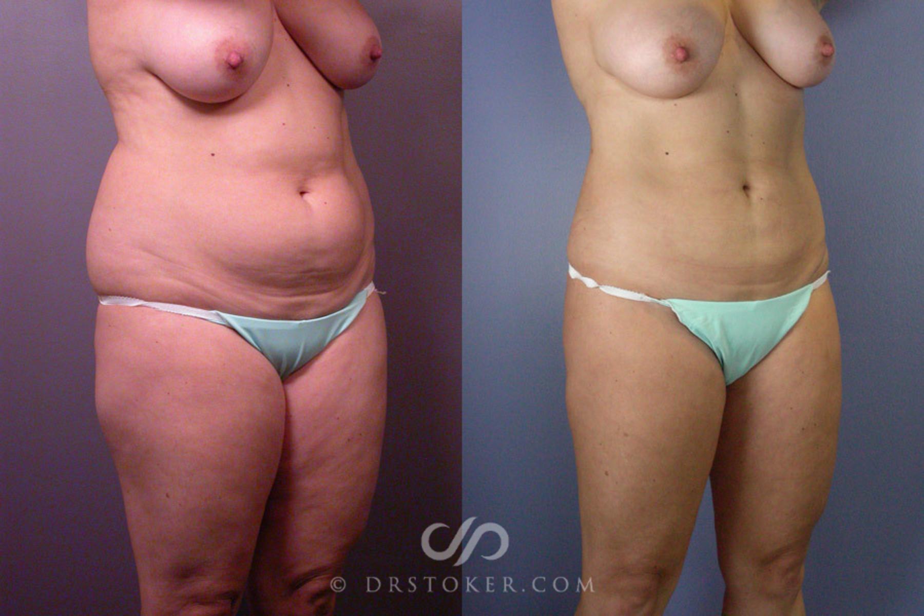 Before & After Liposuction Case 160 View #2 View in Los Angeles, CA