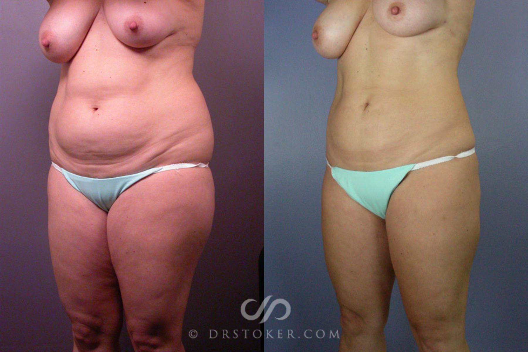 Before & After Liposuction Case 160 View #3 View in Los Angeles, CA