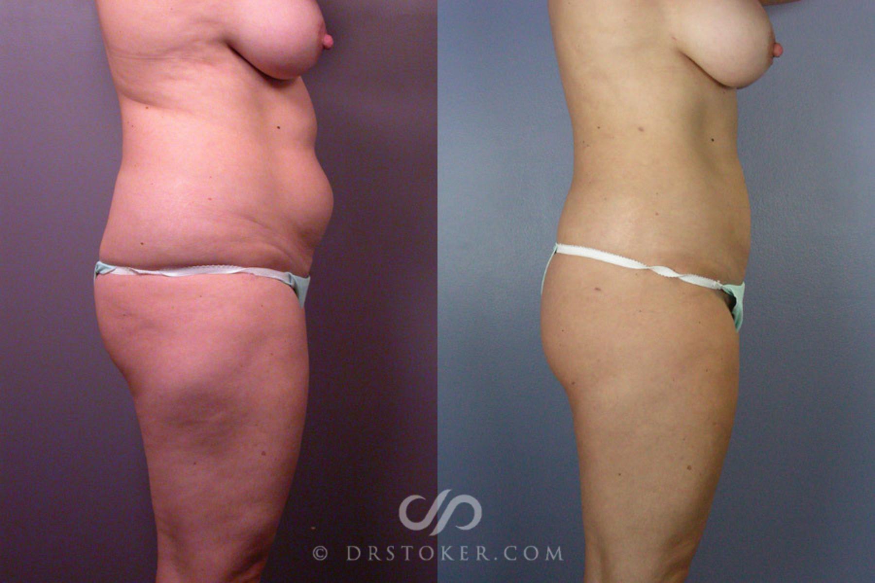 Before & After Liposuction Case 160 View #4 View in Los Angeles, CA