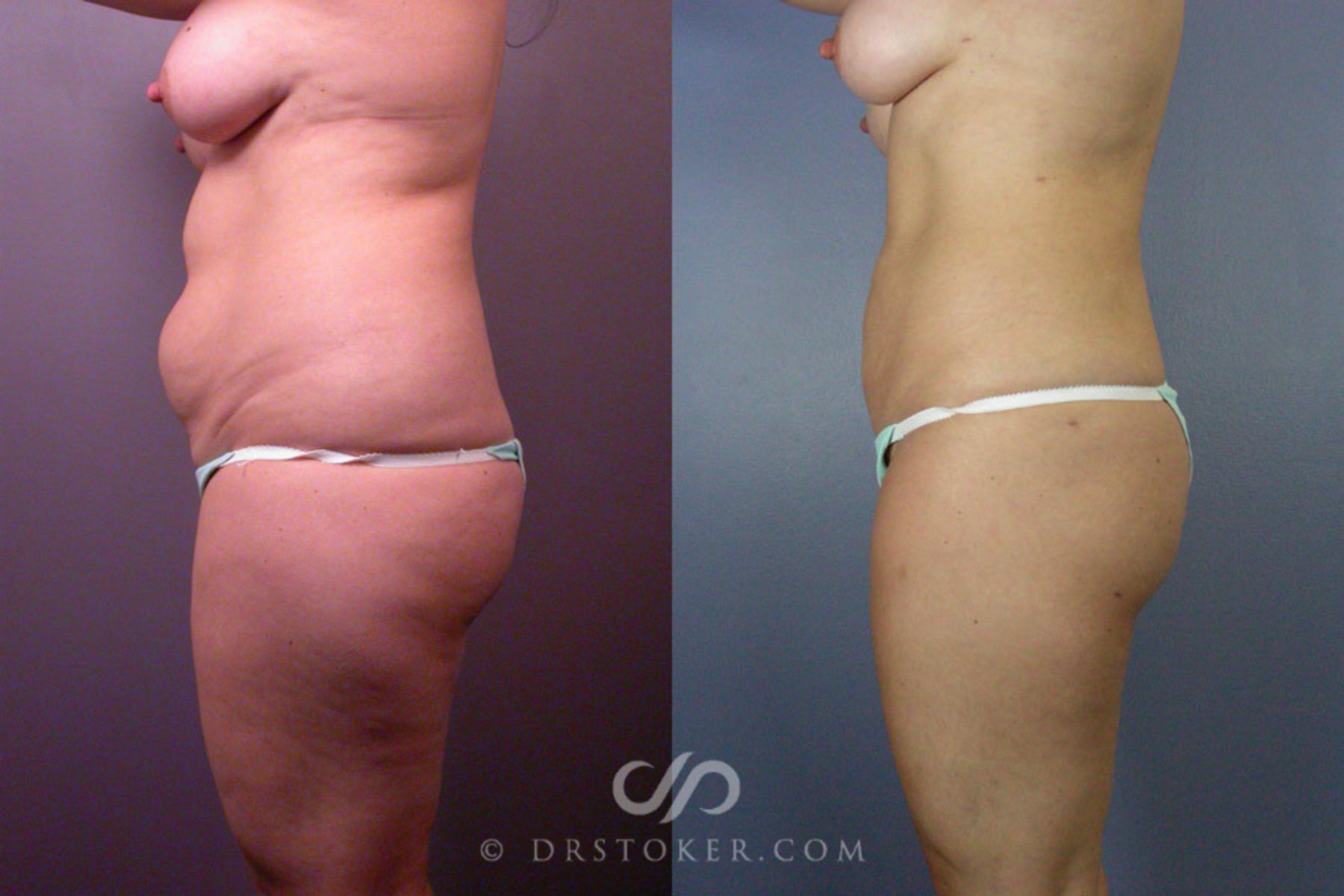 Before & After Liposuction Case 160 View #5 View in Los Angeles, CA