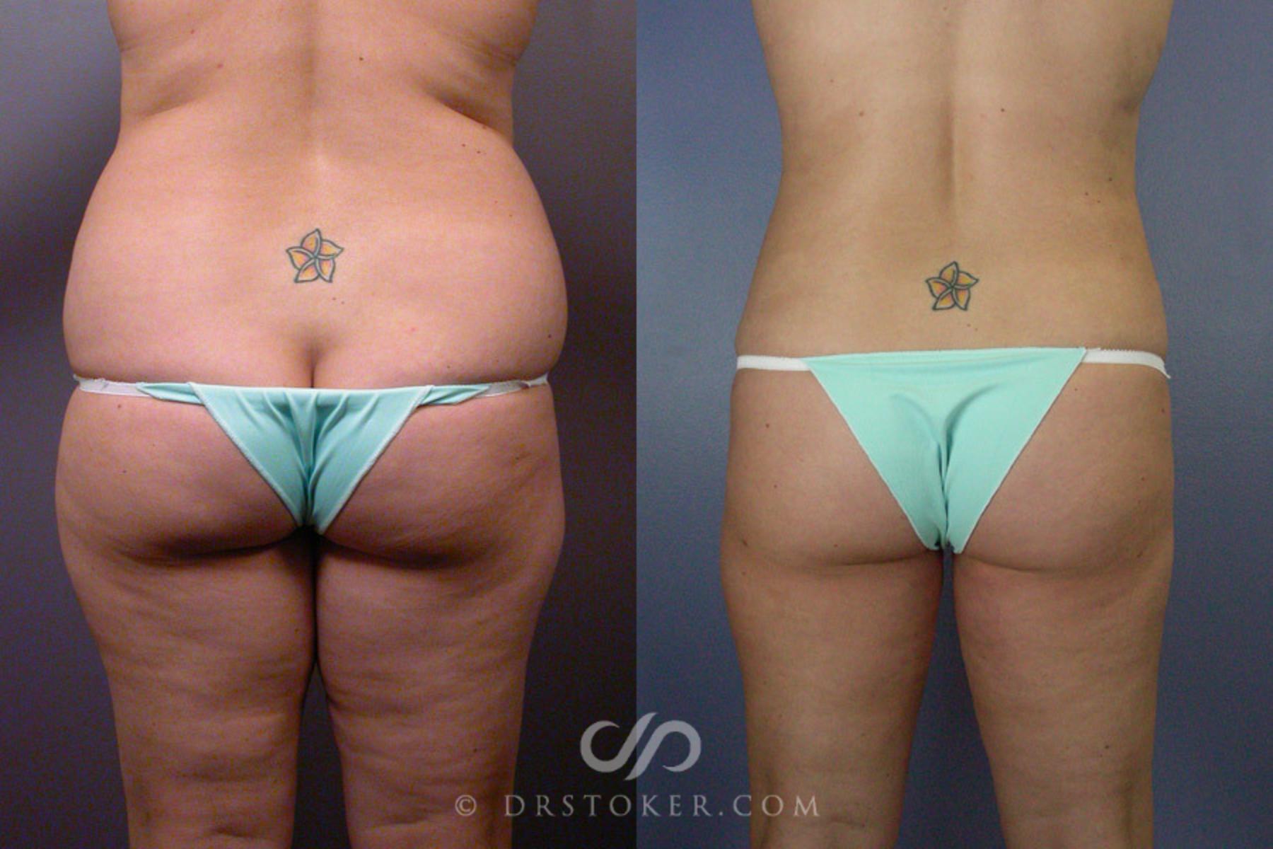 Before & After Liposuction Case 160 View #6 View in Los Angeles, CA