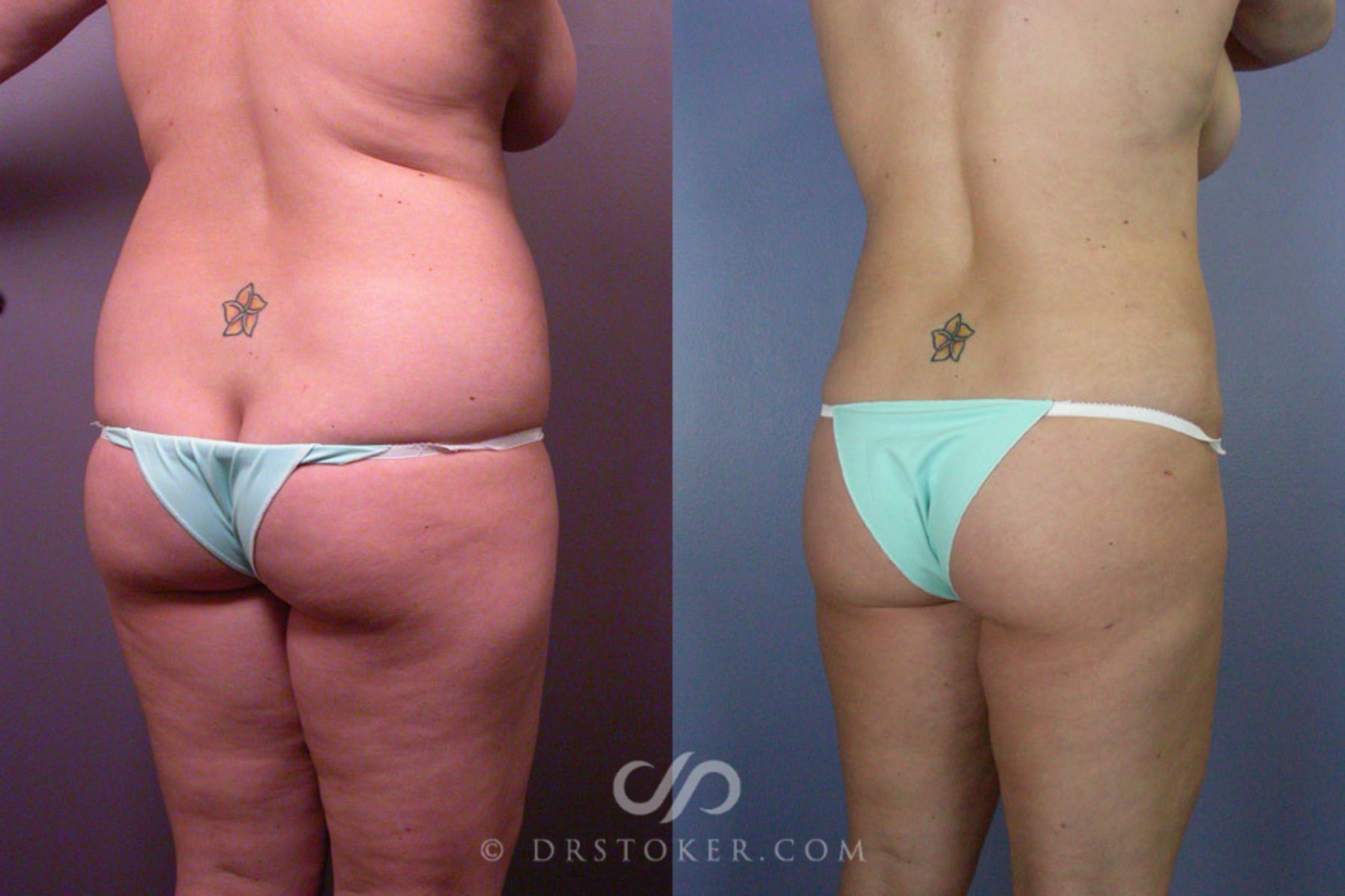 Before & After Liposuction Case 160 View #7 View in Los Angeles, CA