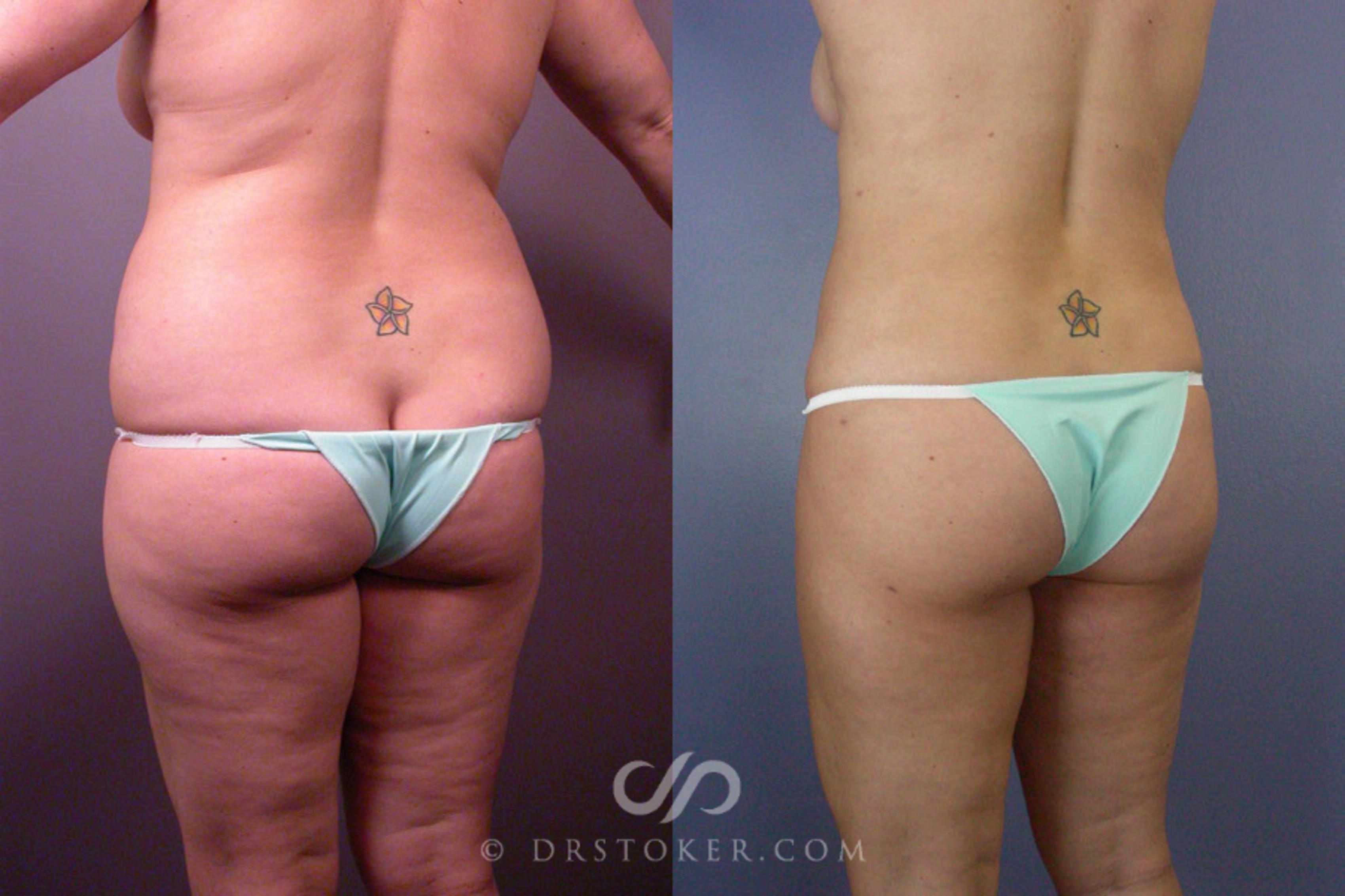 Before & After Liposuction Case 160 View #8 View in Los Angeles, CA