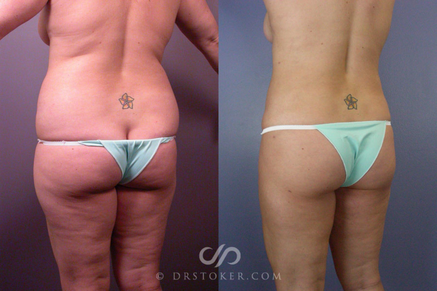 Before & After Liposuction Case 160 View #8 View in Los Angeles, CA