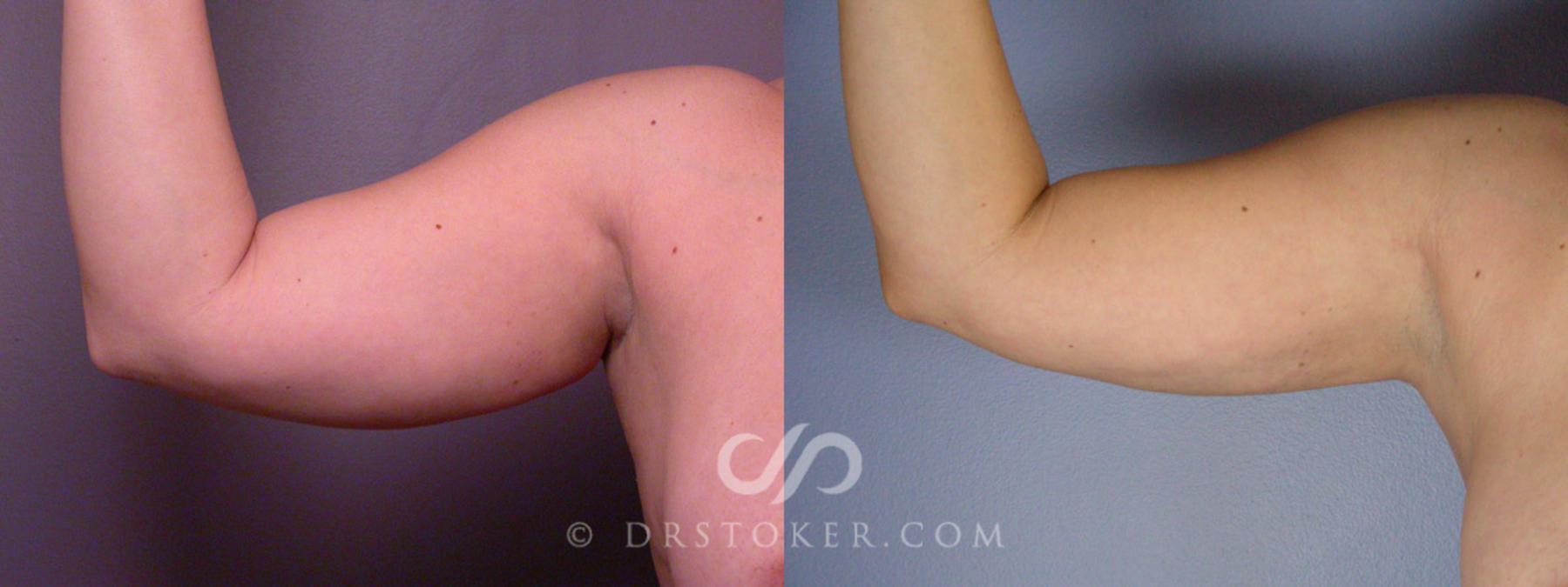 Before & After Liposuction Case 160 View #9 View in Los Angeles, CA