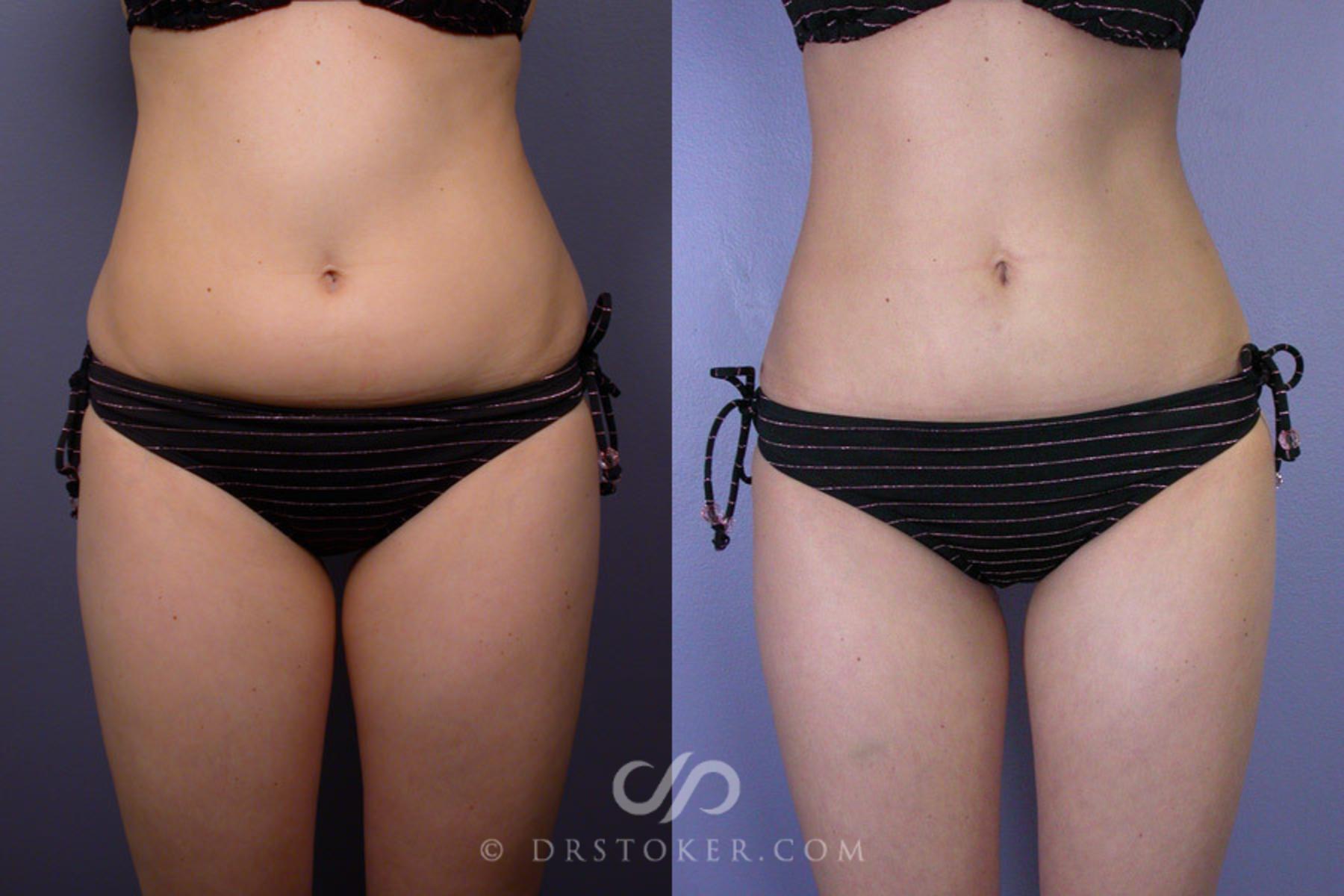 Before & After Liposuction Case 161 View #1 View in Los Angeles, CA
