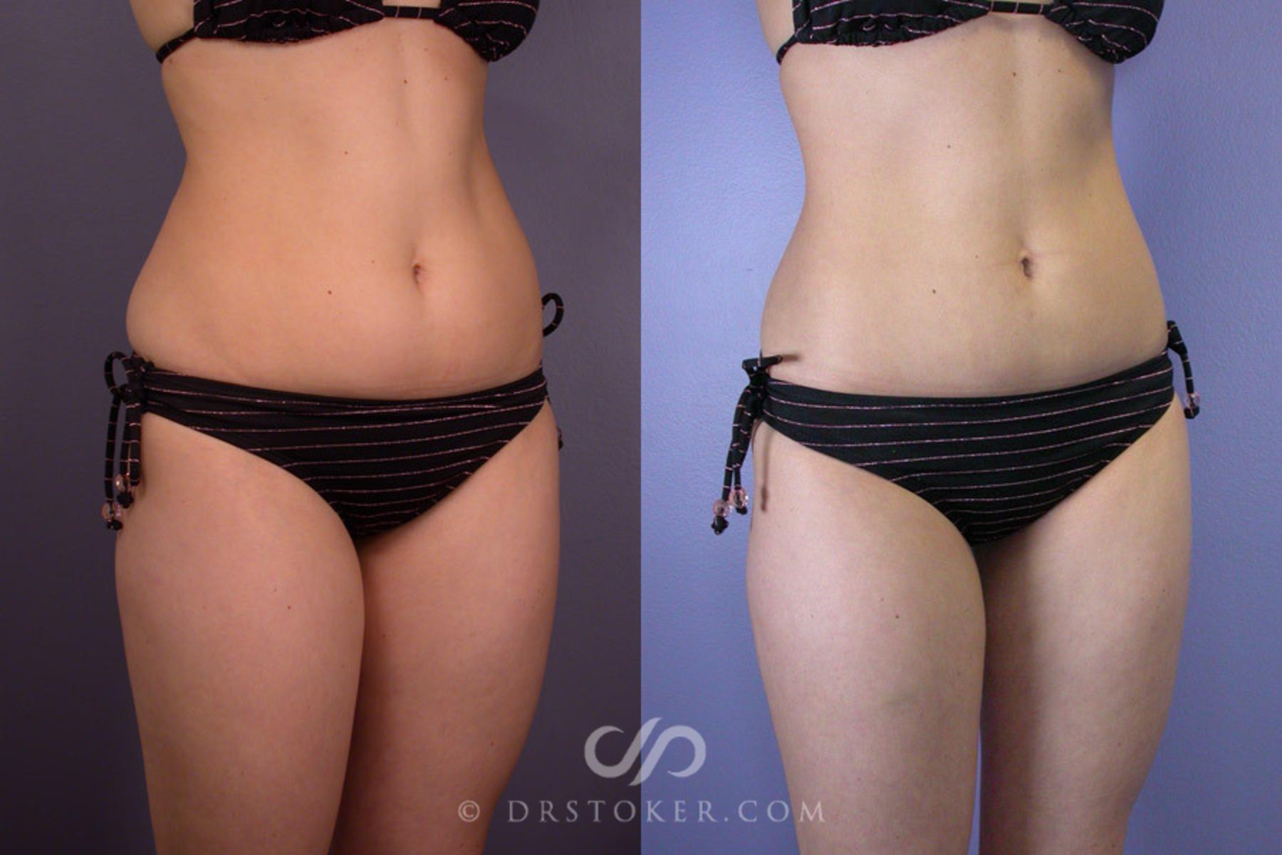 Before & After Liposuction Case 161 View #2 View in Los Angeles, CA