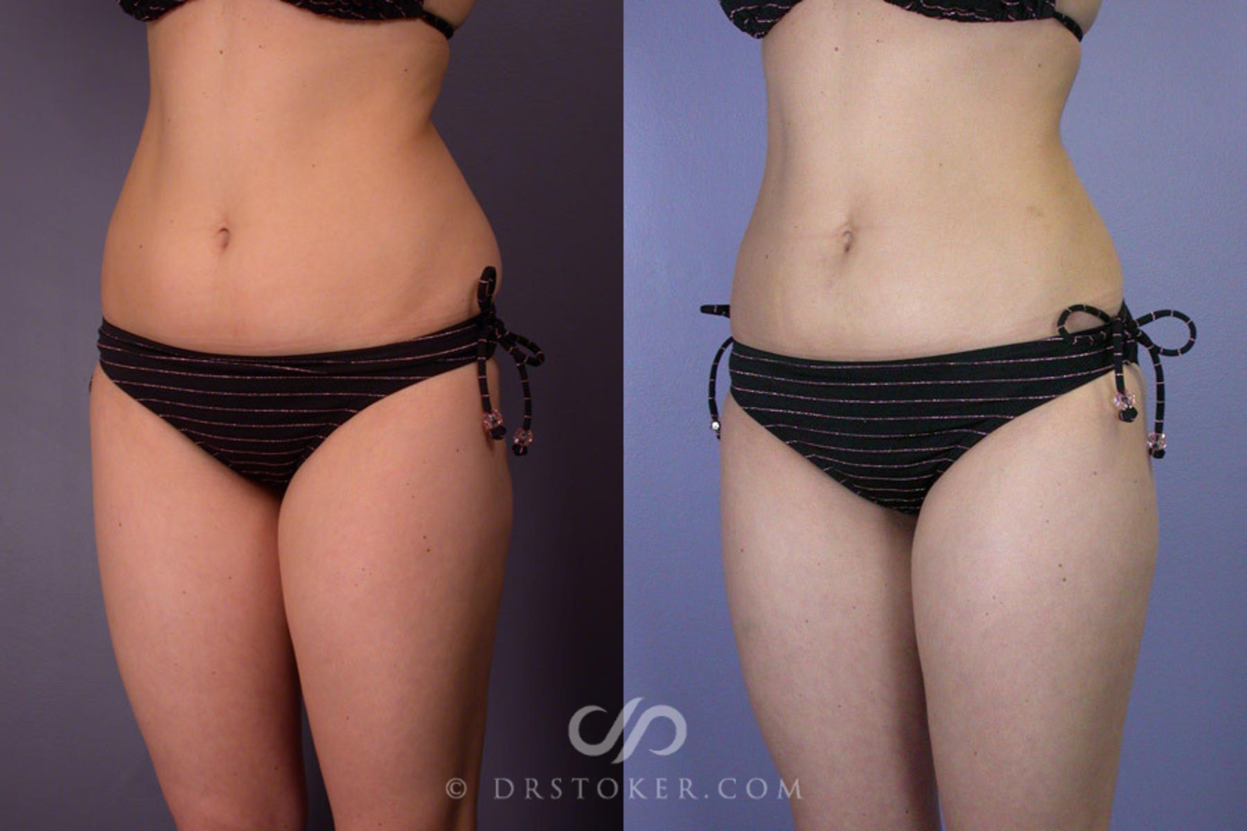 Before & After Liposuction Case 161 View #3 View in Los Angeles, CA