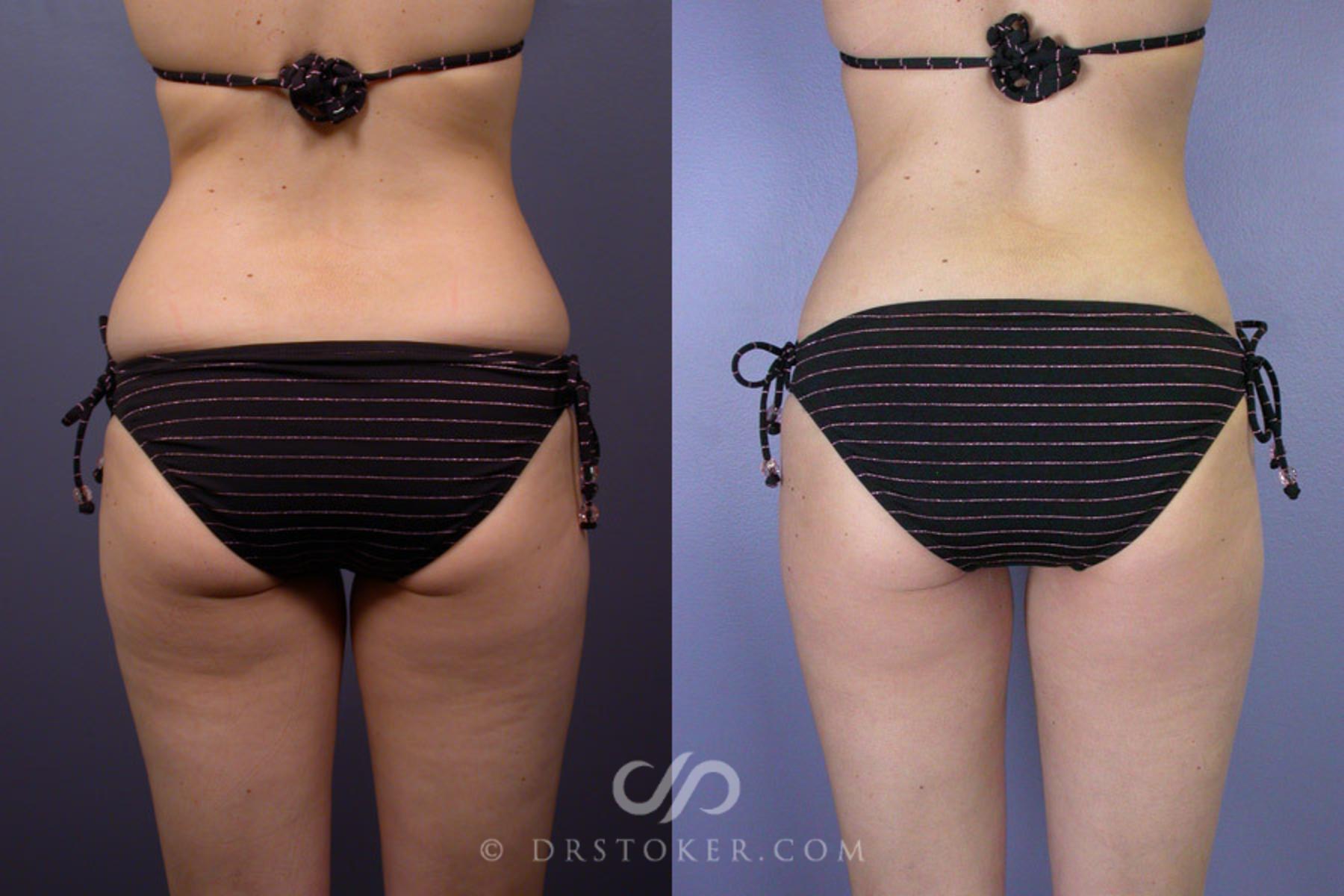 Before & After Liposuction Case 161 View #4 View in Los Angeles, CA