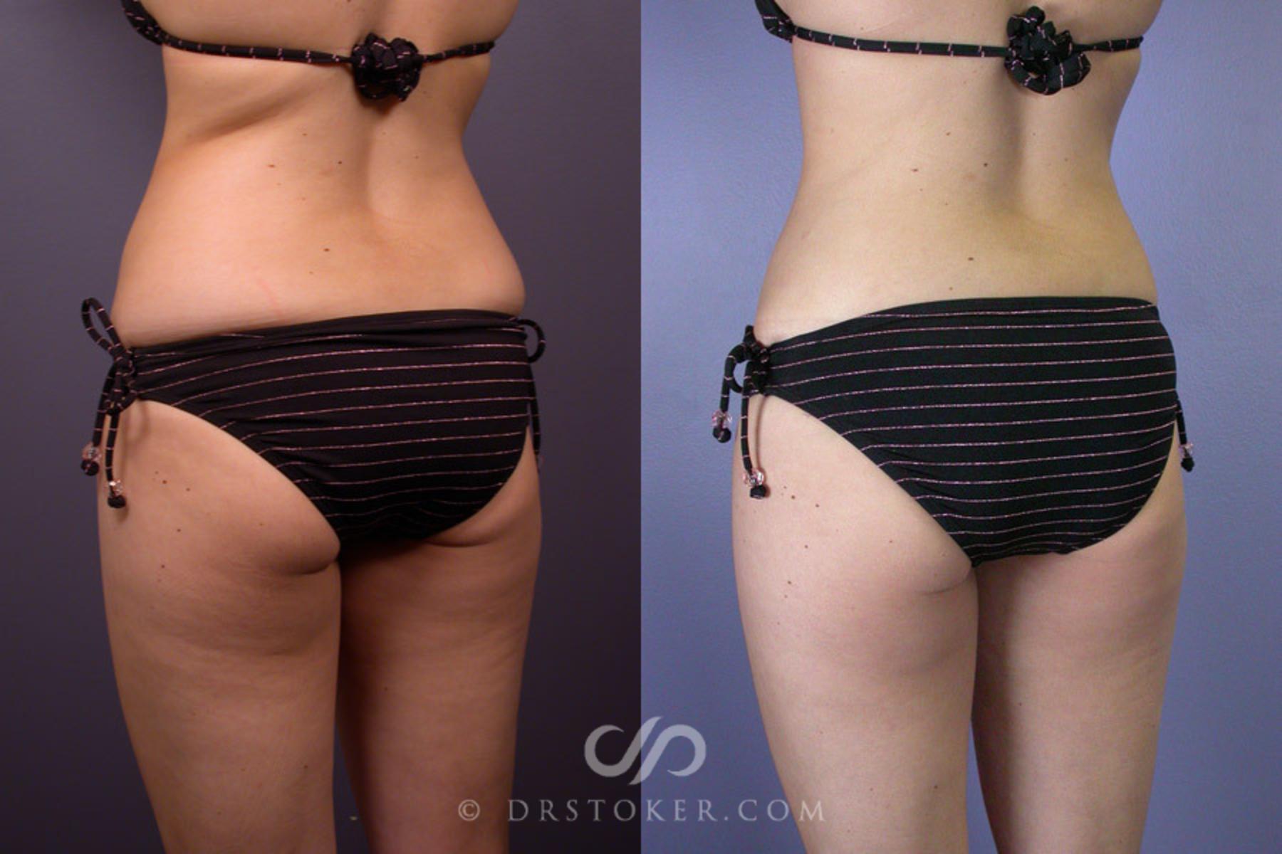 Before & After Liposuction Case 161 View #5 View in Los Angeles, CA