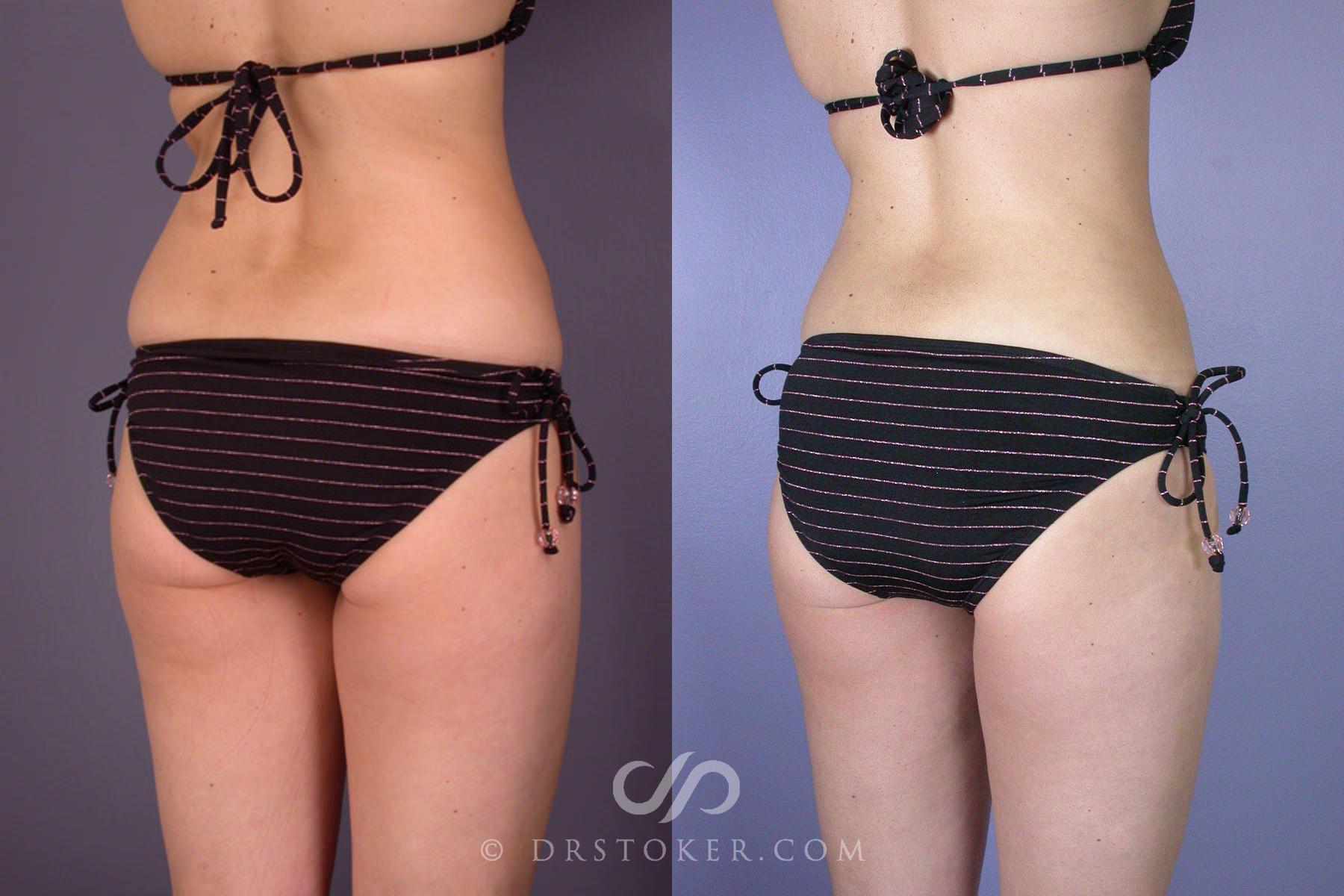 Before & After Liposuction Case 161 View #6 View in Los Angeles, CA