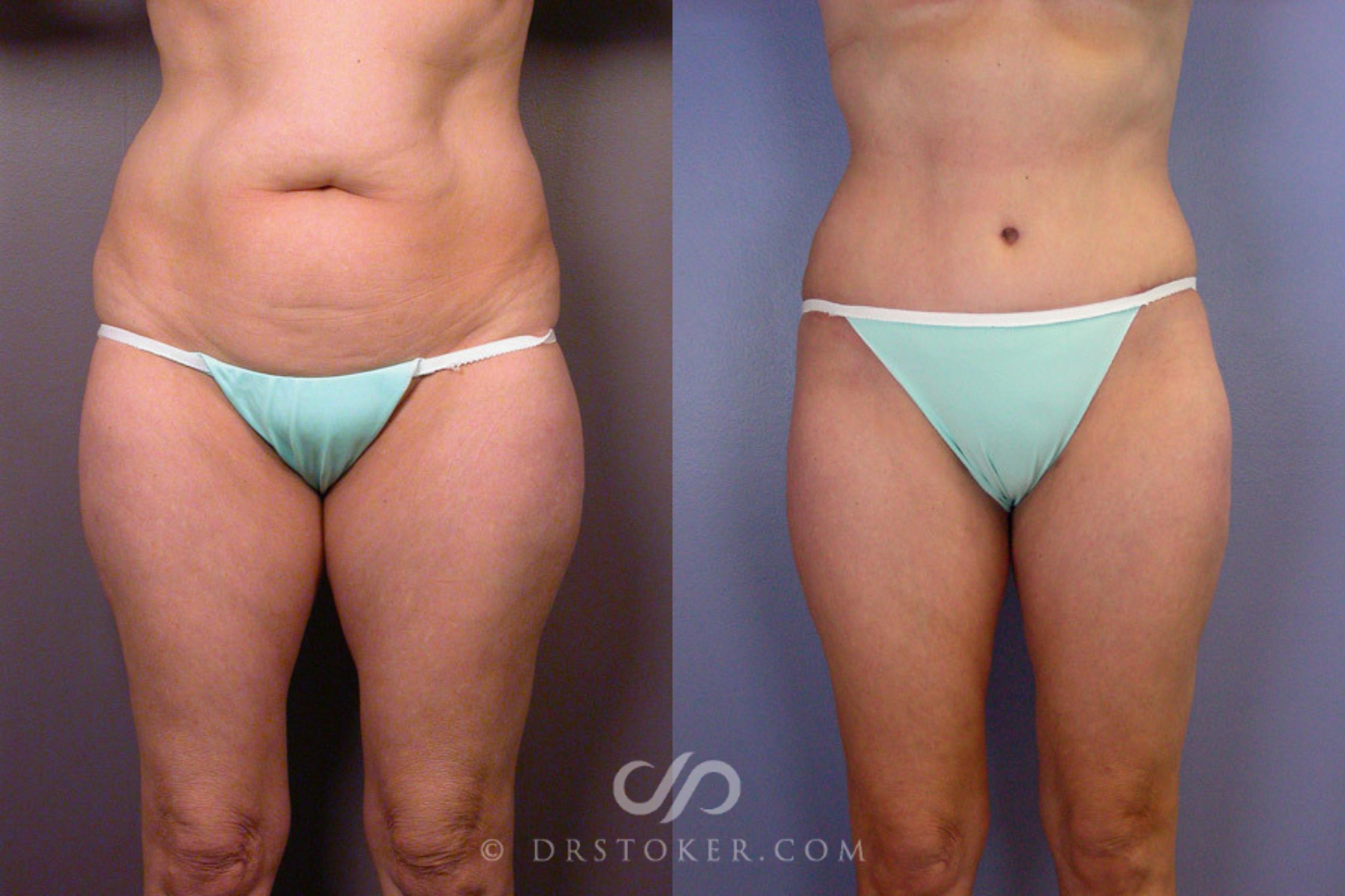 Before & After Tummy Tuck Case 162 View #1 View in Los Angeles, CA