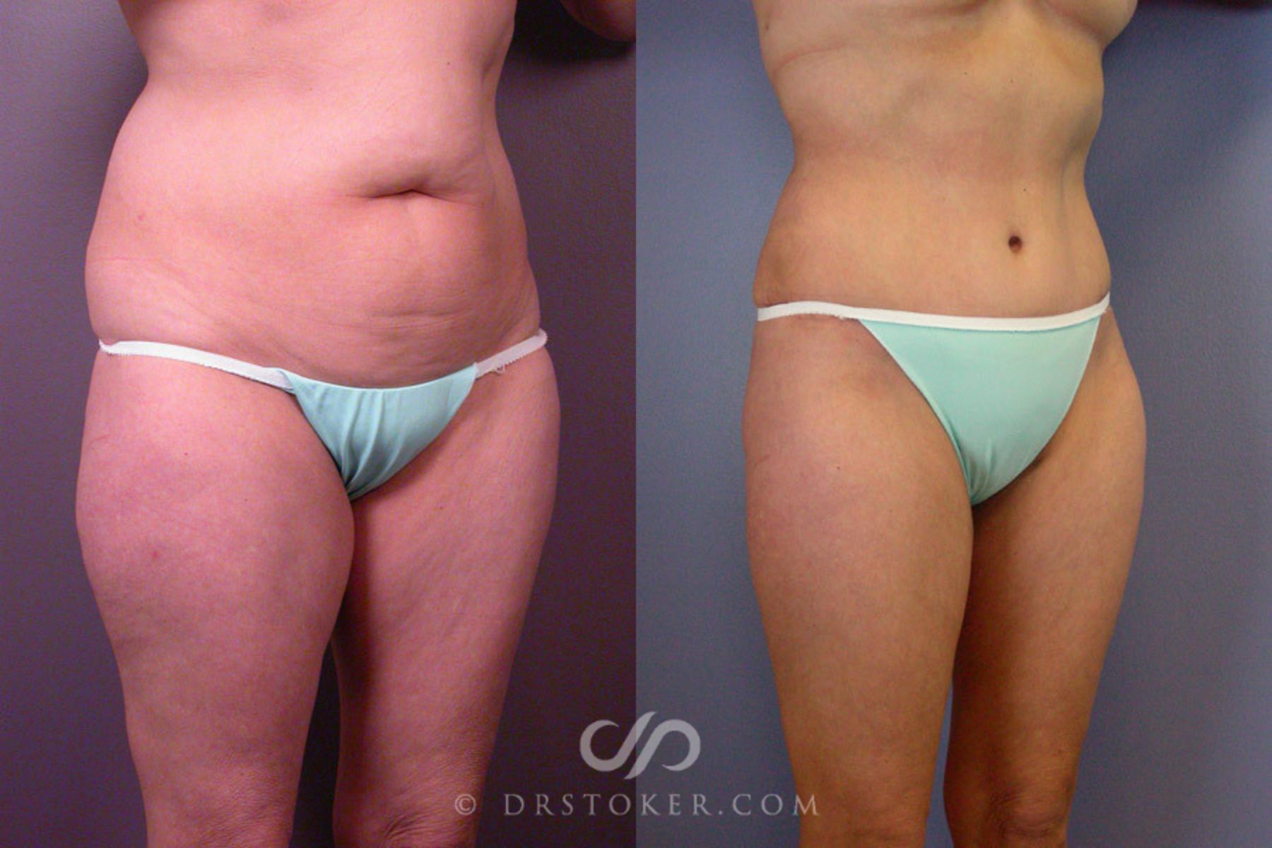 Before & After Liposuction Case 162 View #2 View in Los Angeles, CA