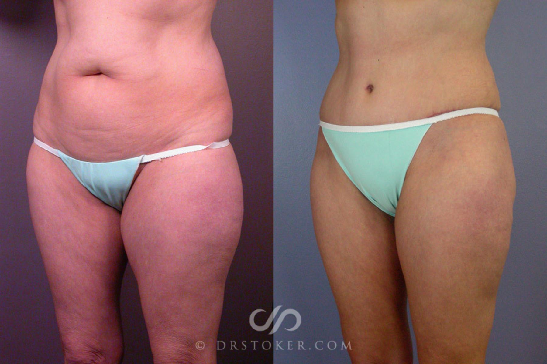 Before & After Liposuction Case 162 View #3 View in Los Angeles, CA