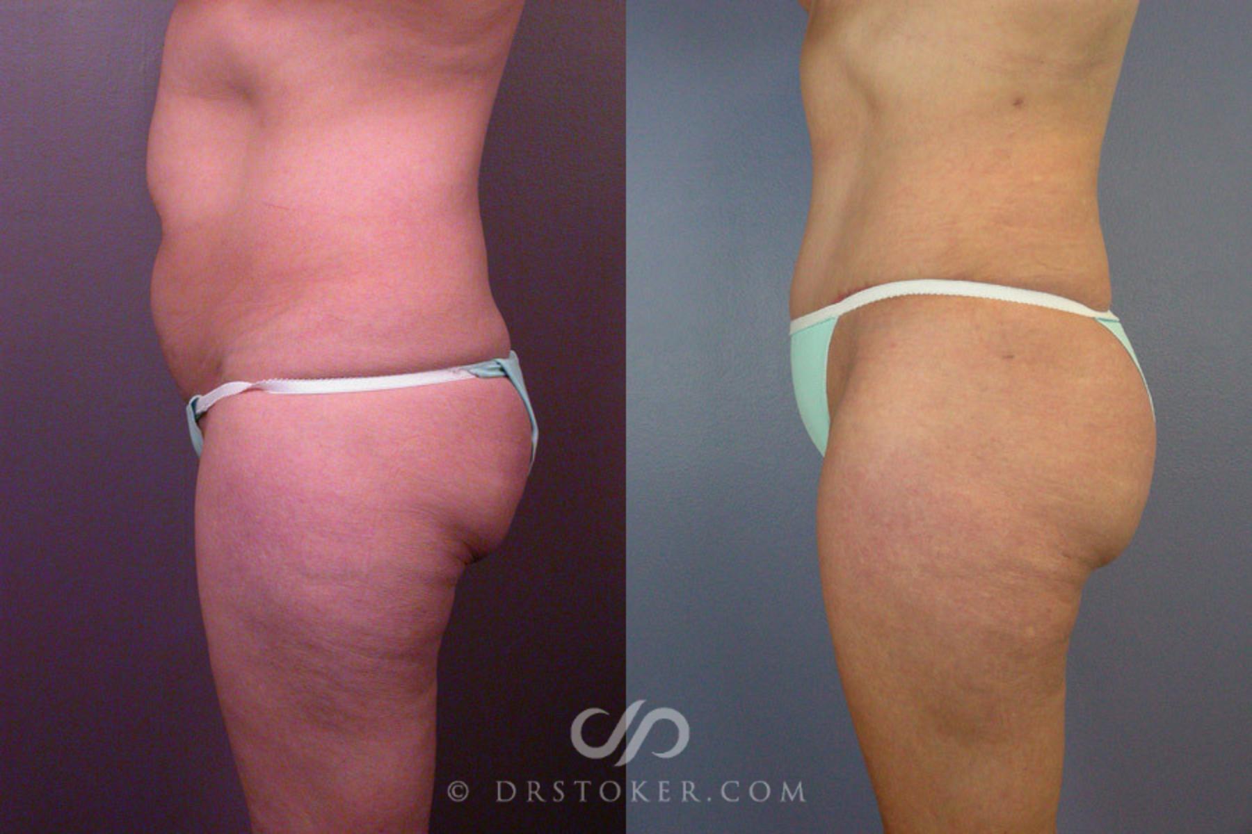 Before & After Liposuction Case 162 View #4 View in Los Angeles, CA