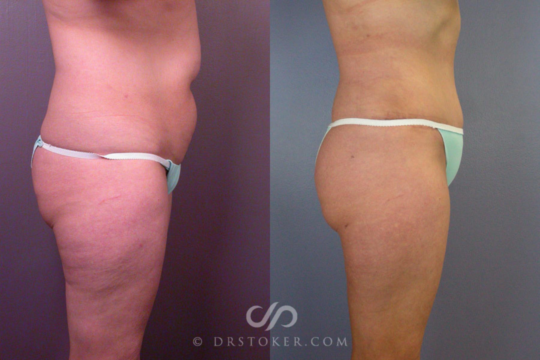 Before & After Liposuction Case 162 View #5 View in Los Angeles, CA