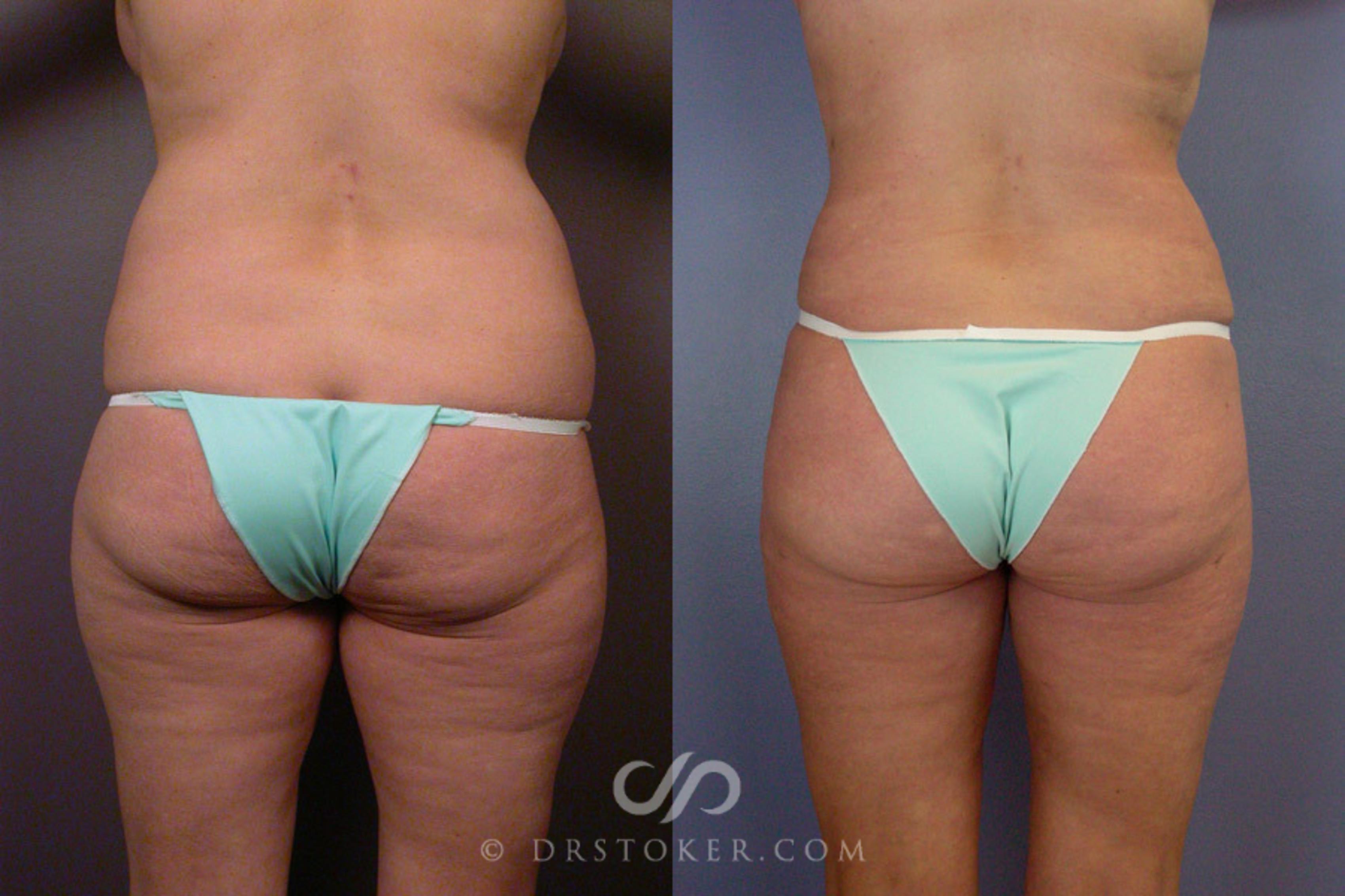 Before & After Liposuction Case 162 View #6 View in Los Angeles, CA