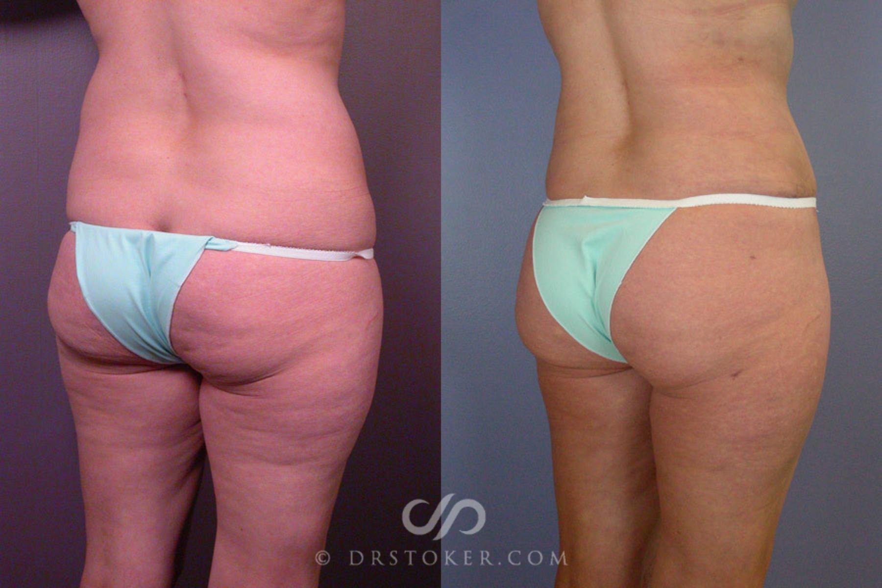Before & After Liposuction Case 162 View #7 View in Los Angeles, CA