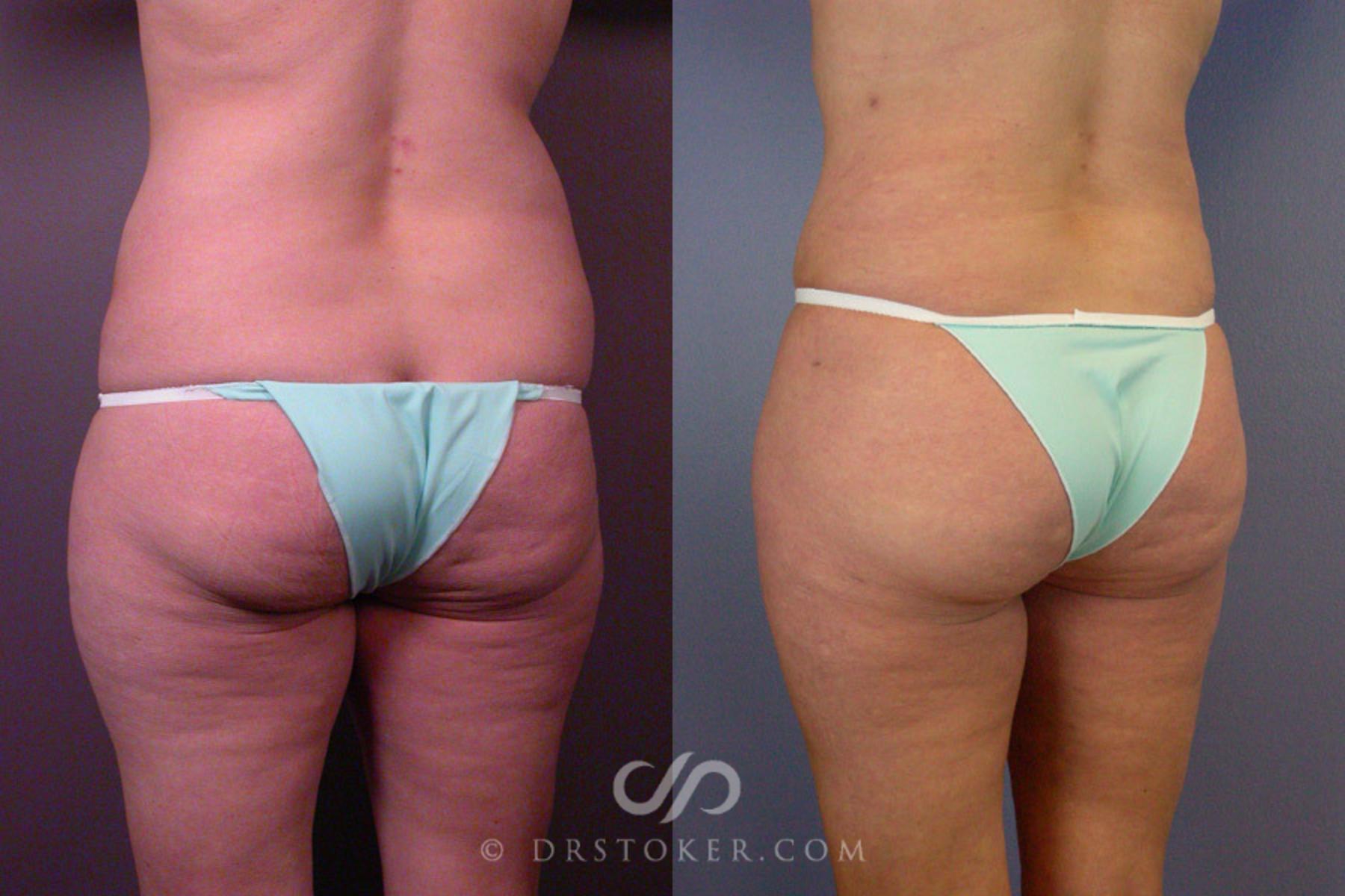 Before & After Liposuction Case 162 View #8 View in Los Angeles, CA
