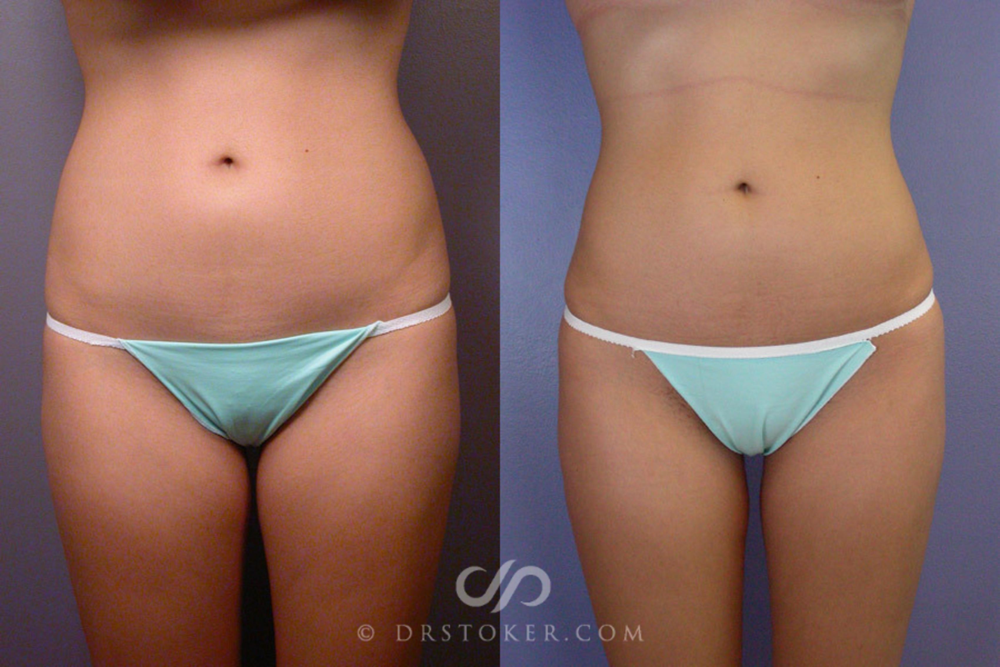 Before & After Liposuction Case 163 View #1 View in Marina del Rey, CA