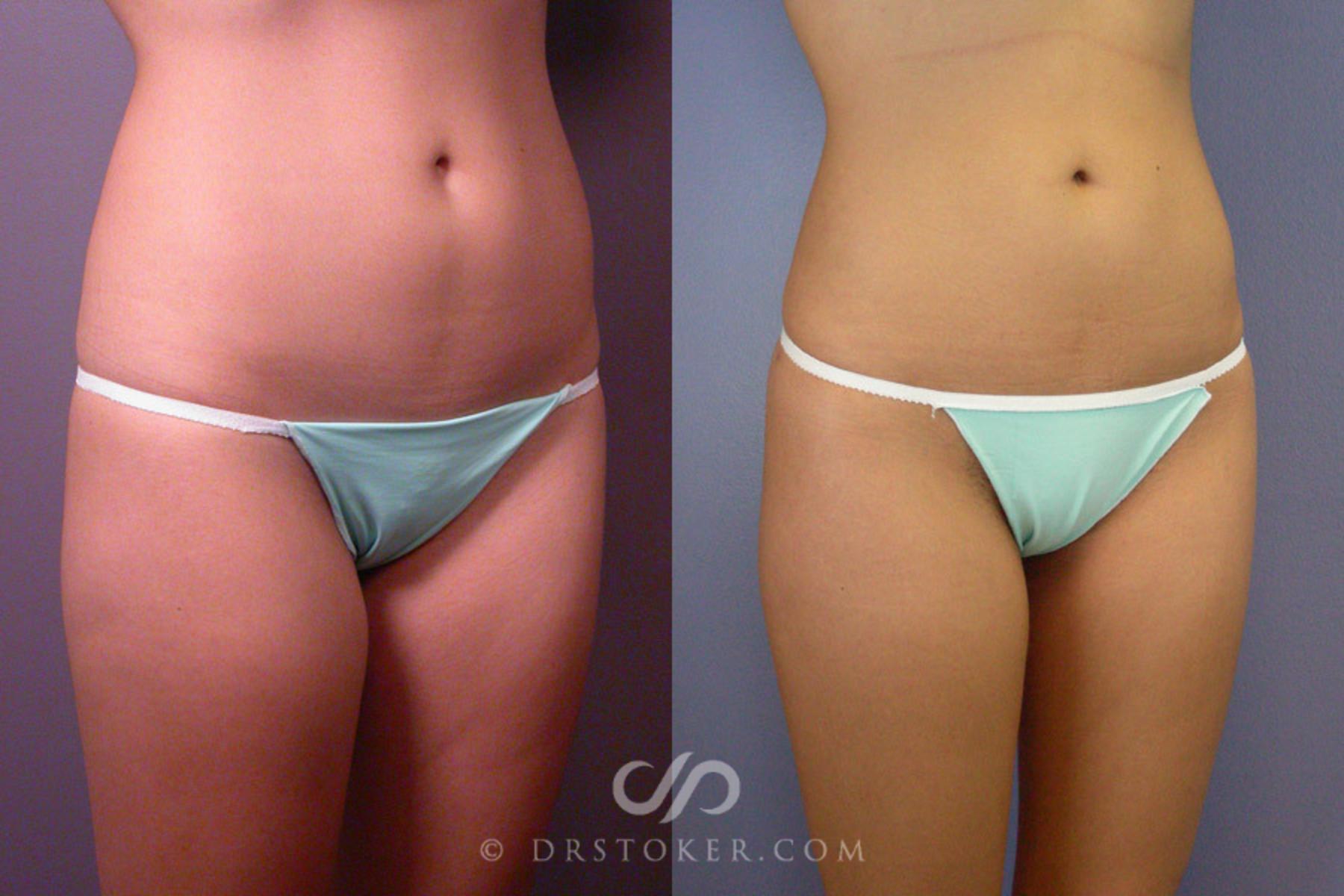Before & After Liposuction Case 163 View #2 View in Los Angeles, CA