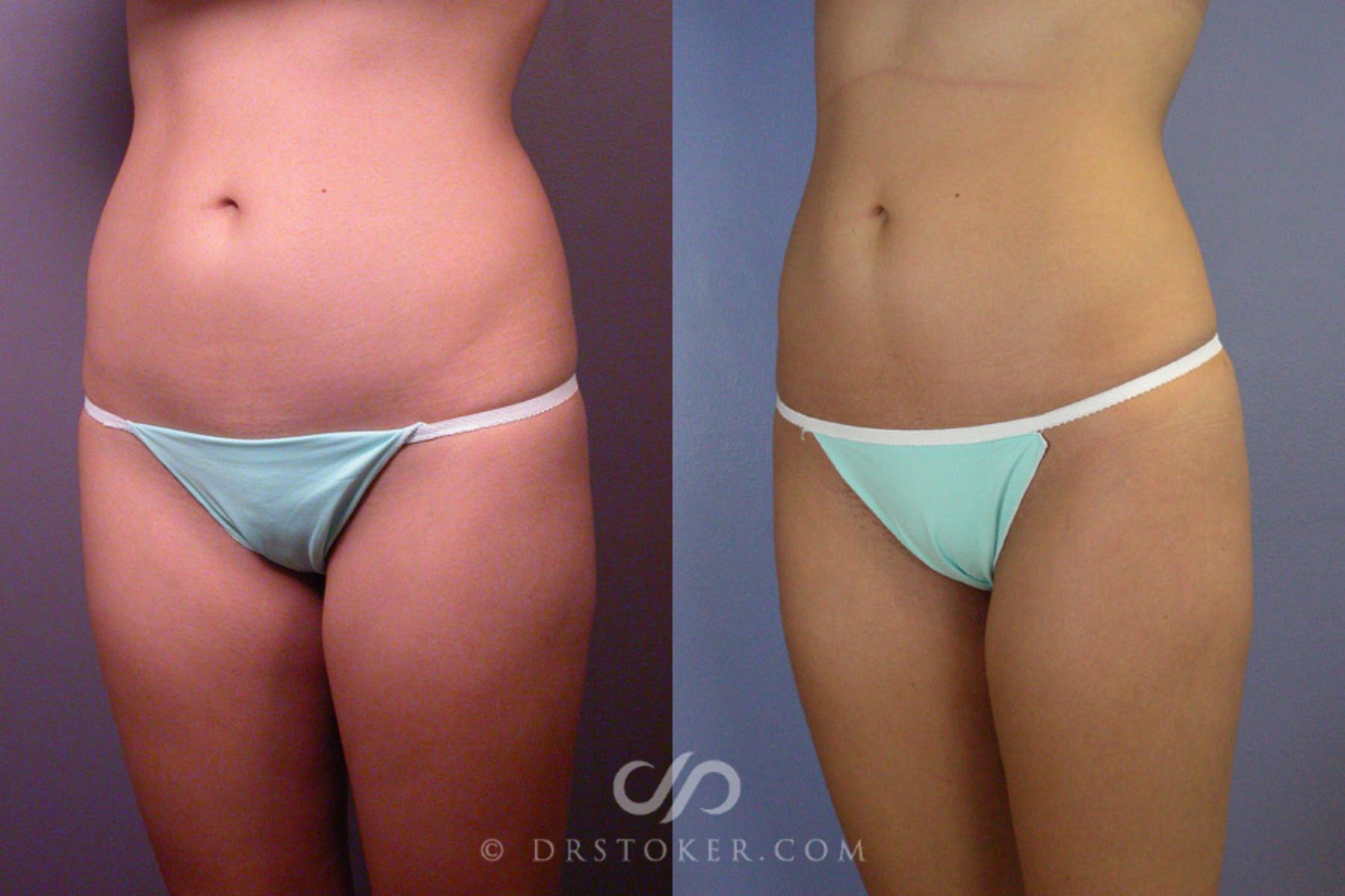 Before & After Liposuction Case 163 View #3 View in Los Angeles, CA