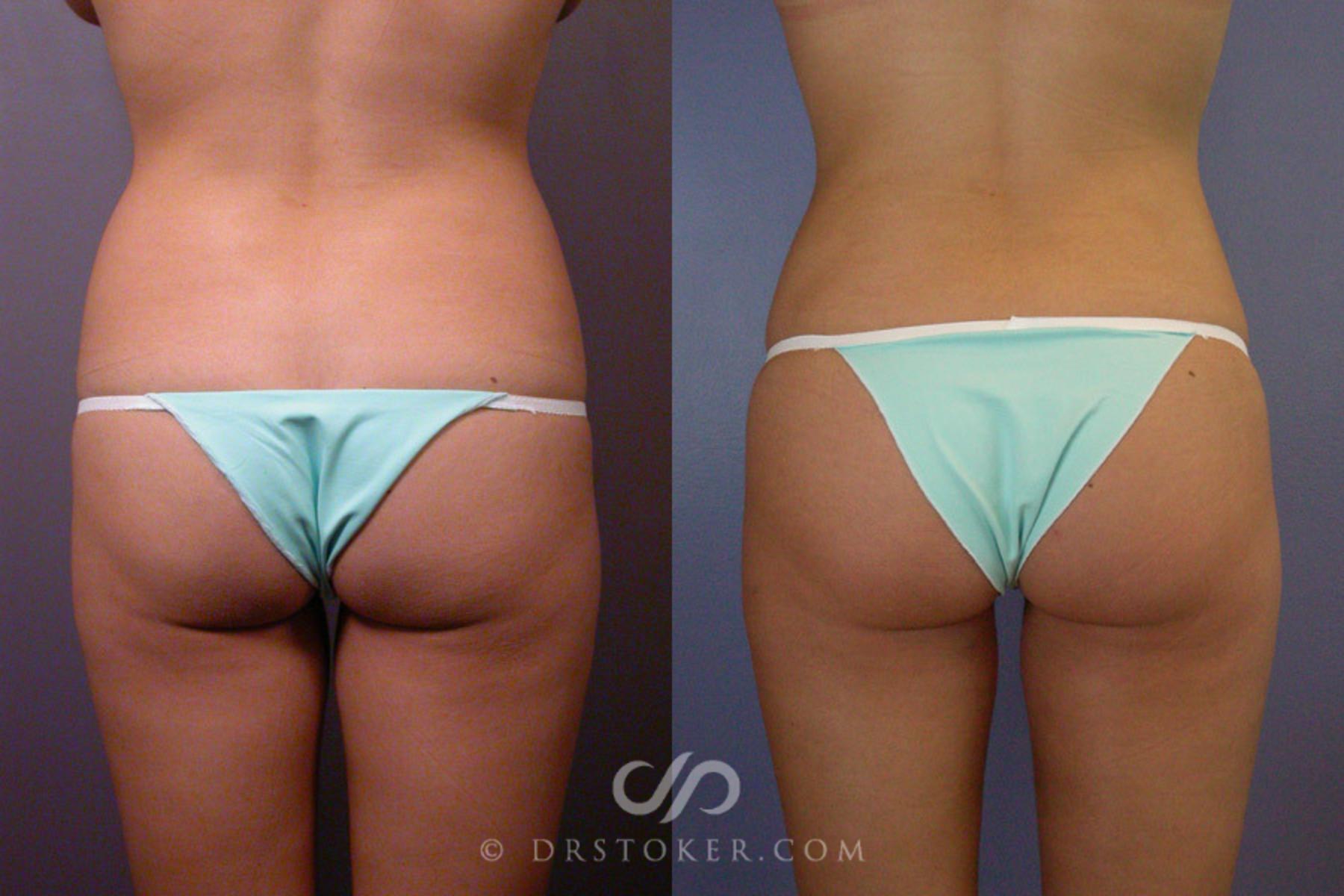 Before & After Liposuction Case 163 View #4 View in Los Angeles, CA