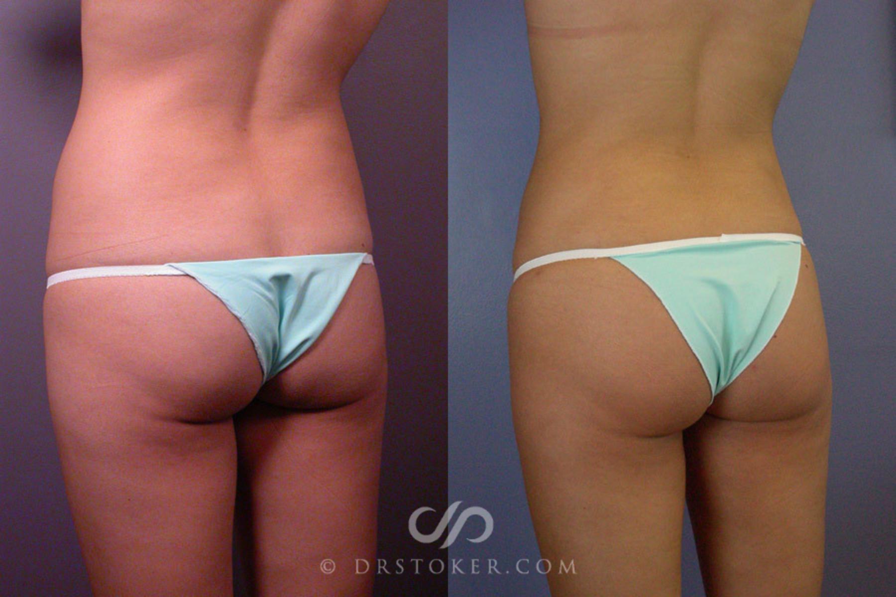 Before & After Liposuction Case 163 View #5 View in Los Angeles, CA