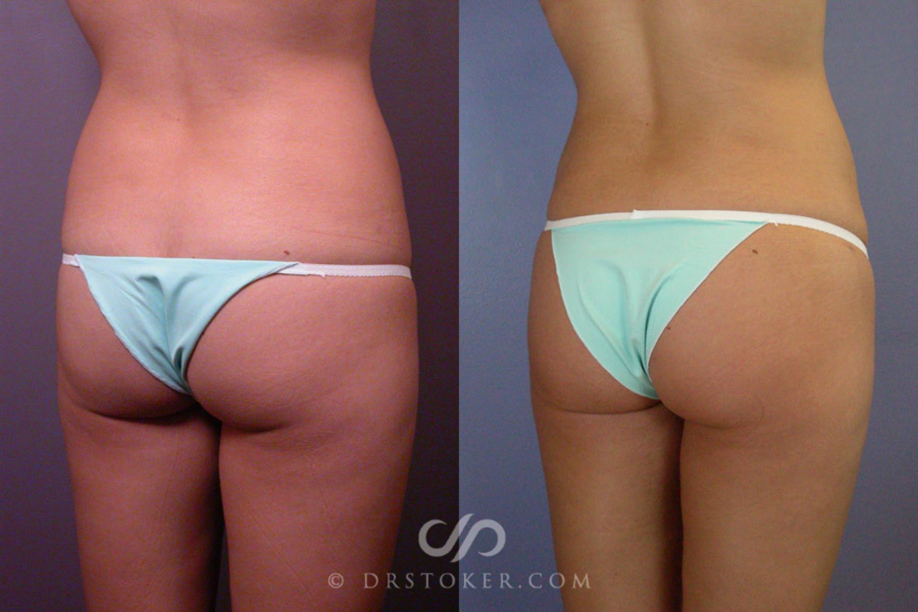 Before & After Liposuction Case 163 View #7 View in Los Angeles, CA