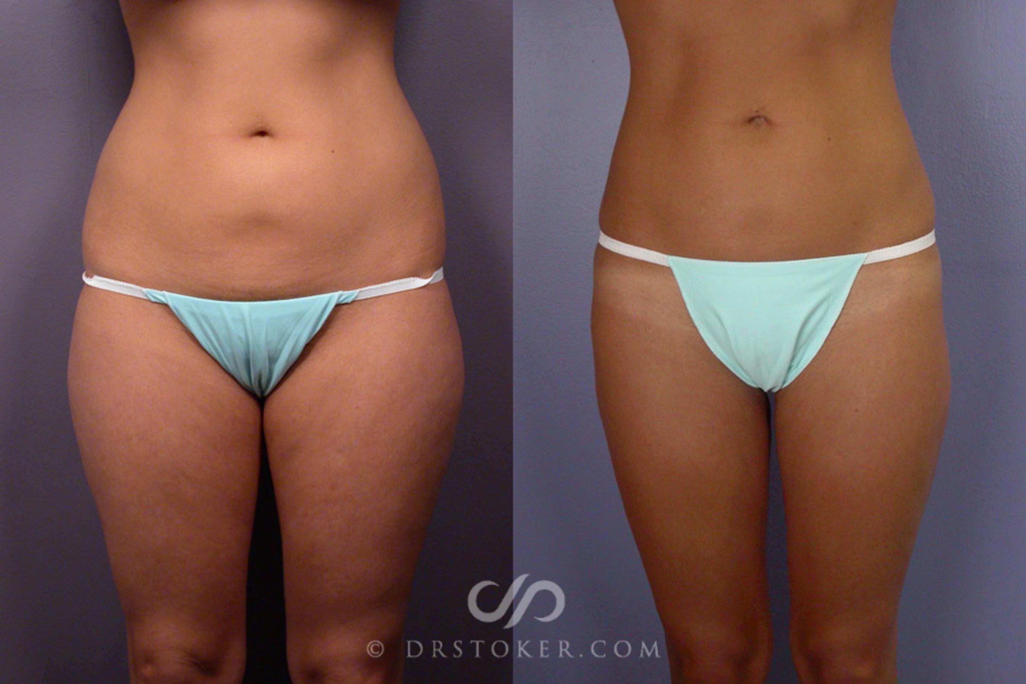 Before & After Liposuction Case 164 View #1 View in Los Angeles, CA