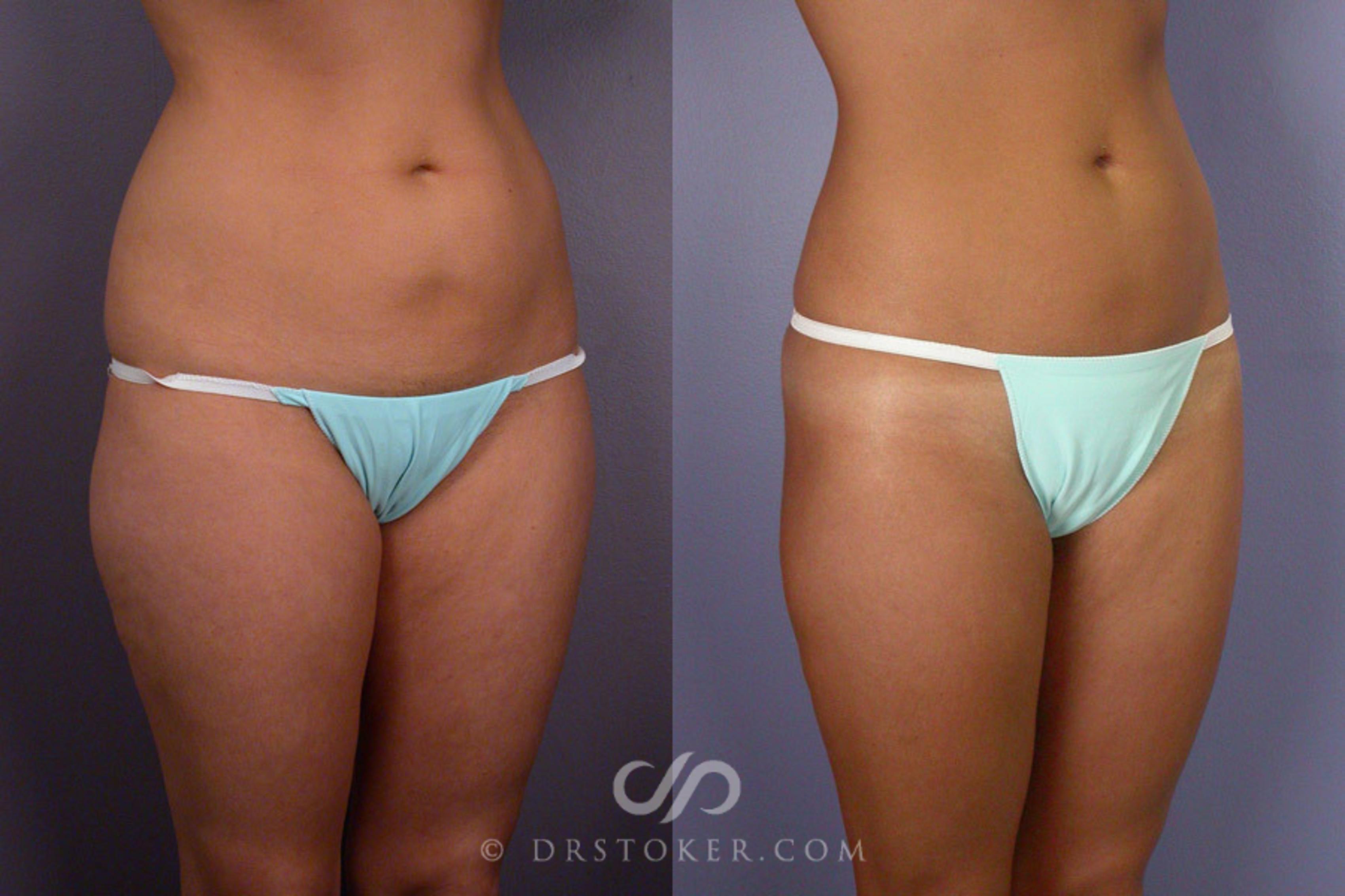 Before & After Liposuction Case 164 View #2 View in Los Angeles, CA