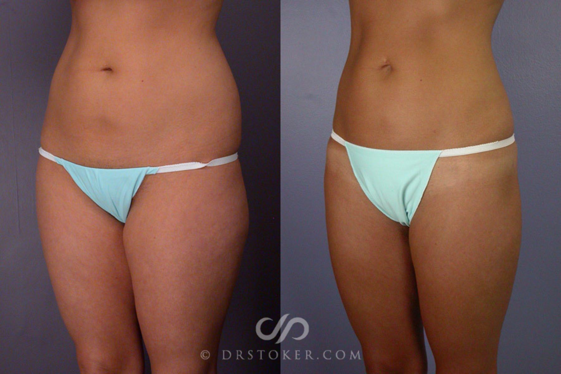 Before & After Liposuction Case 164 View #3 View in Los Angeles, CA