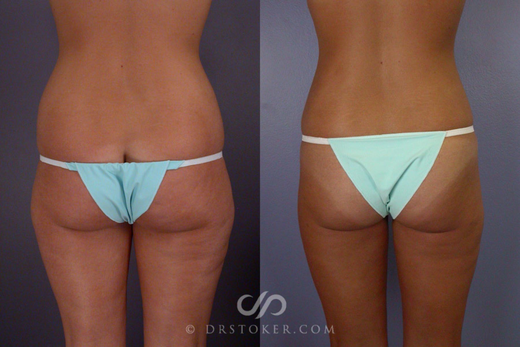 Before & After Liposuction Case 164 View #4 View in Los Angeles, CA