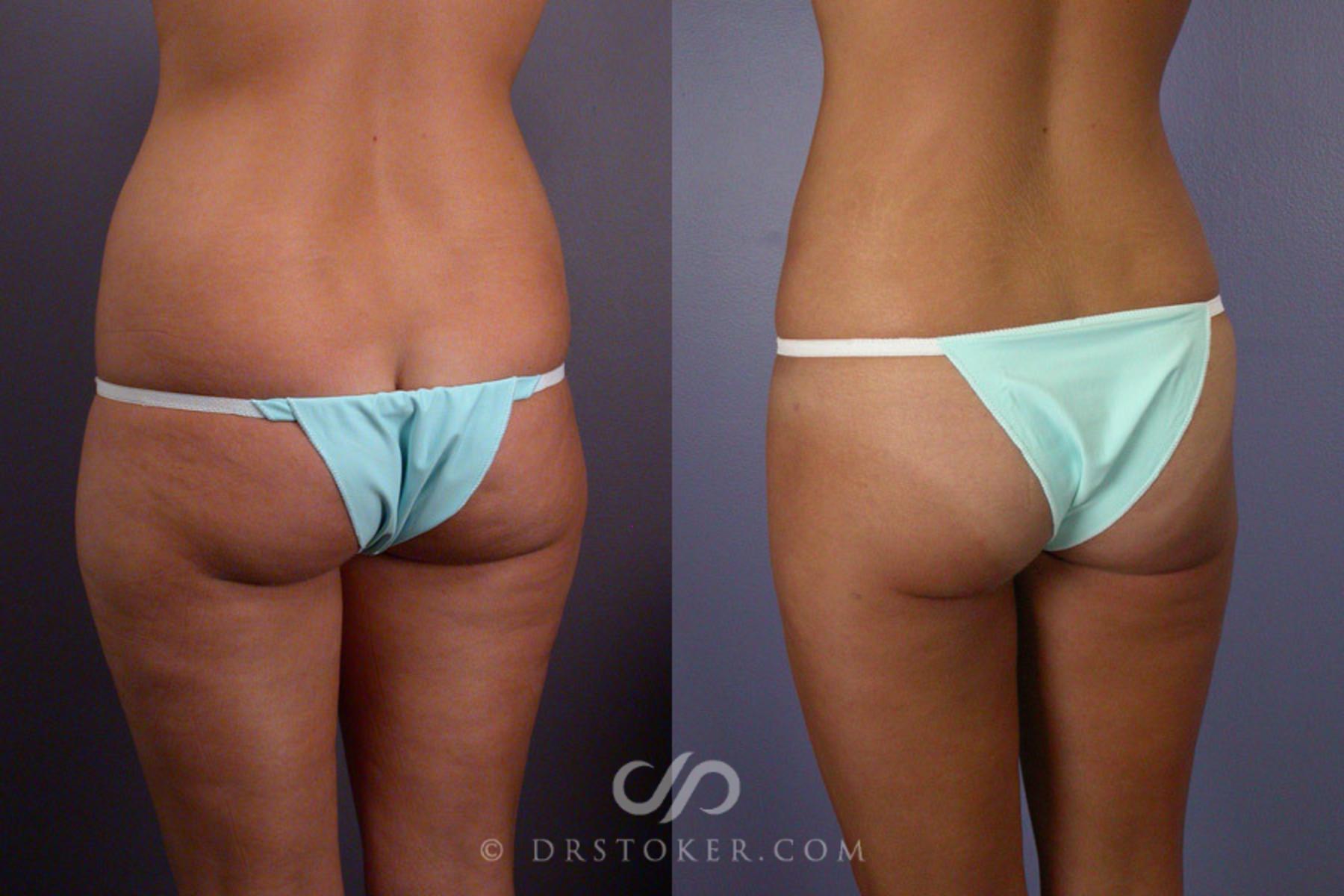 Before & After Liposuction Case 164 View #5 View in Los Angeles, CA