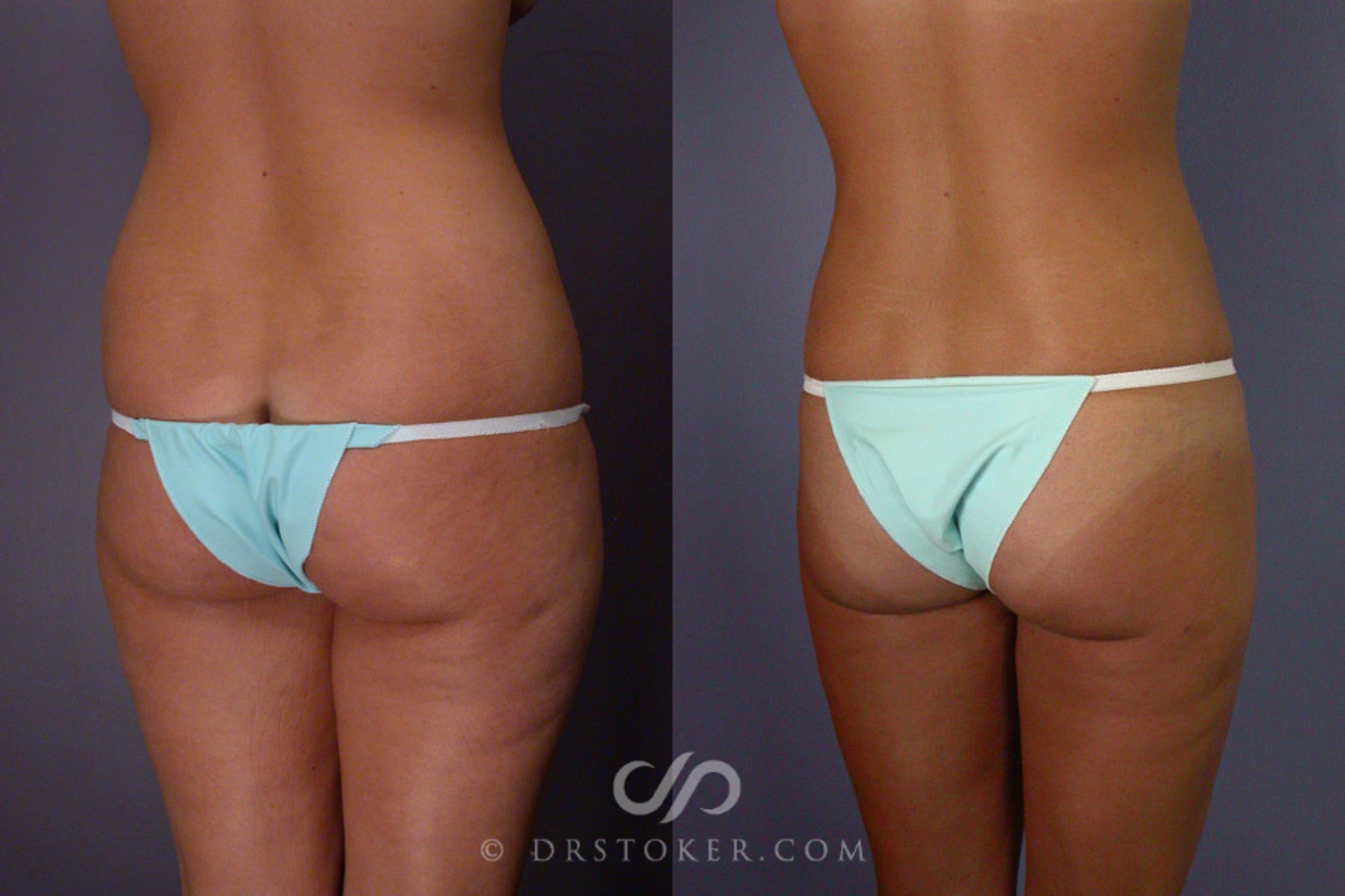 Before & After Liposuction Case 164 View #6 View in Los Angeles, CA