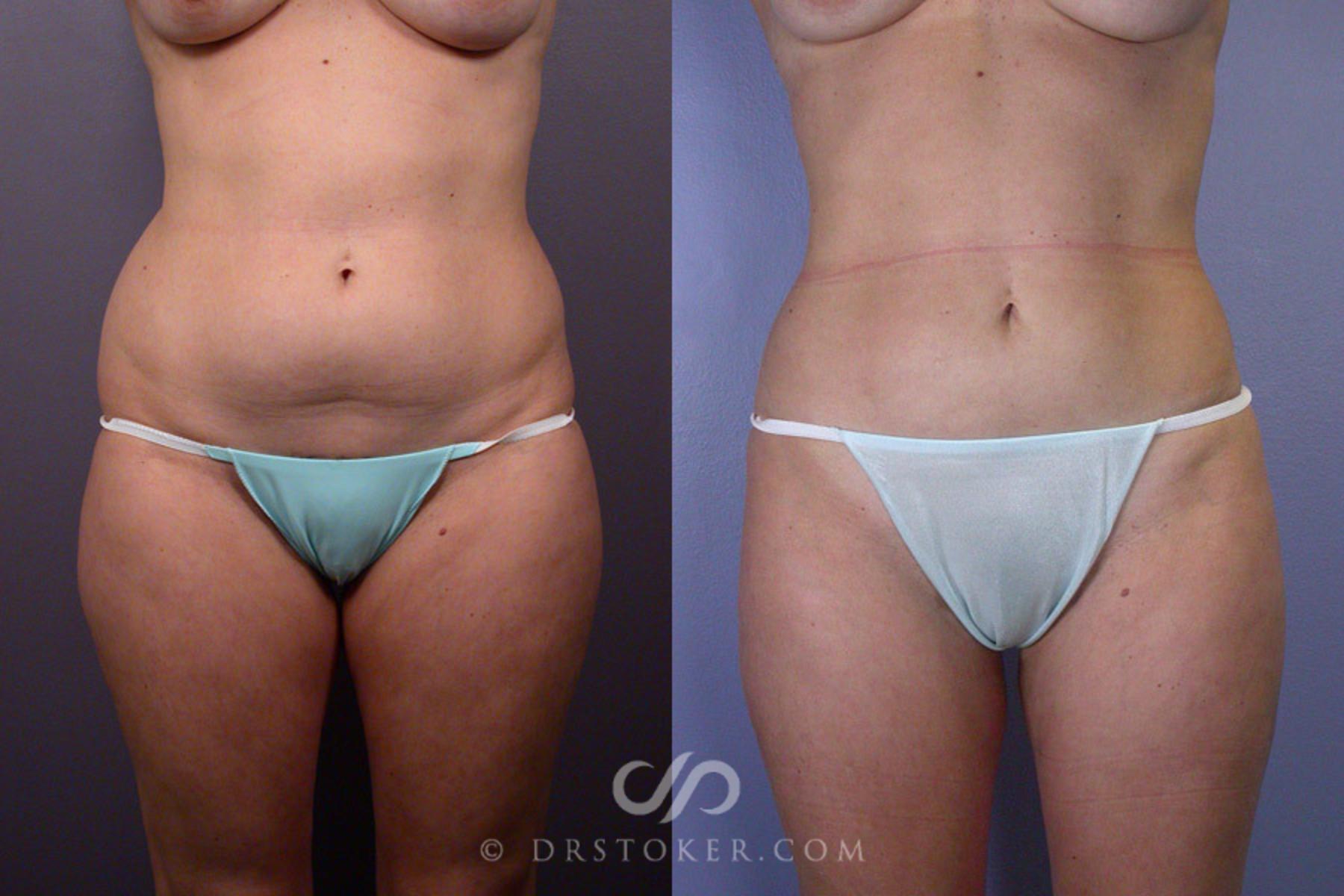 Before & After Liposuction Case 165 View #1 View in Los Angeles, CA