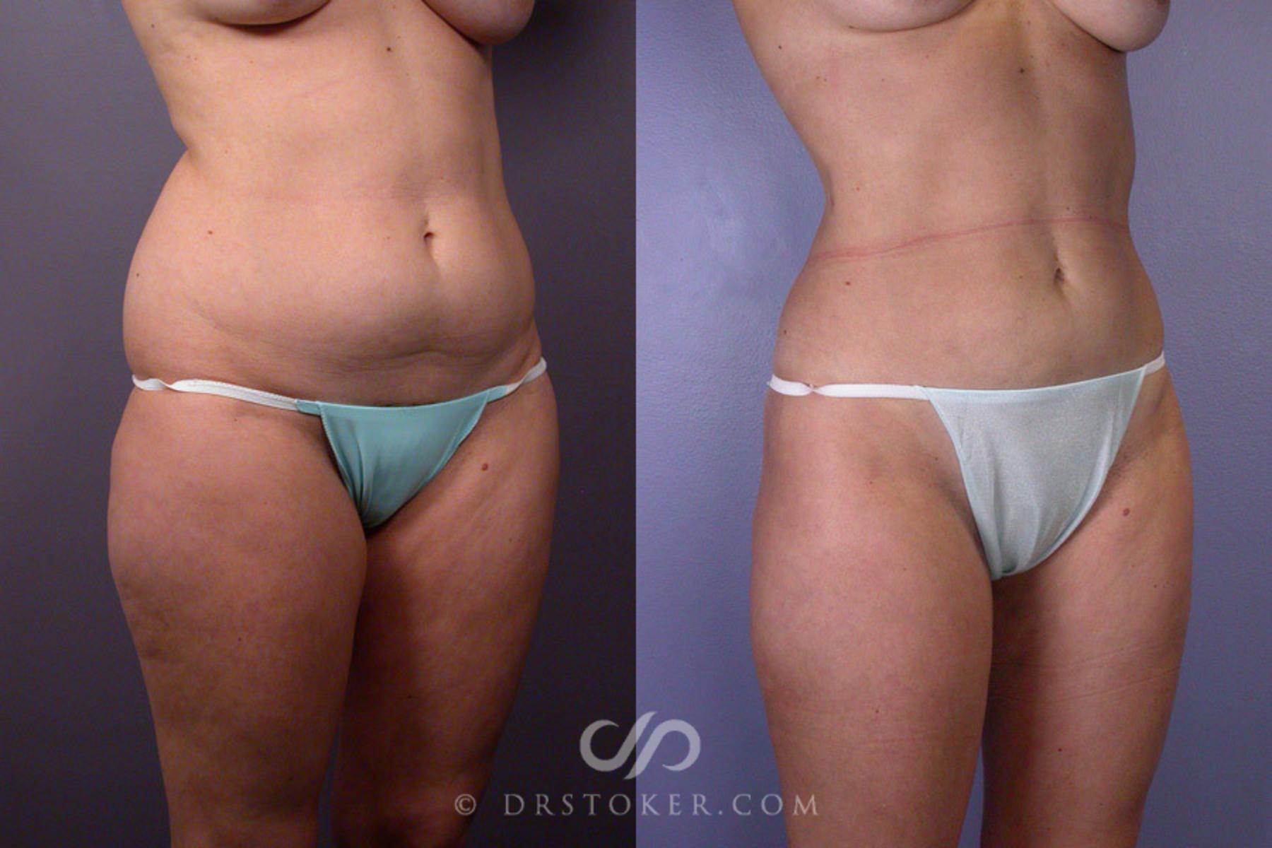 Before & After Liposuction Case 165 View #2 View in Los Angeles, CA