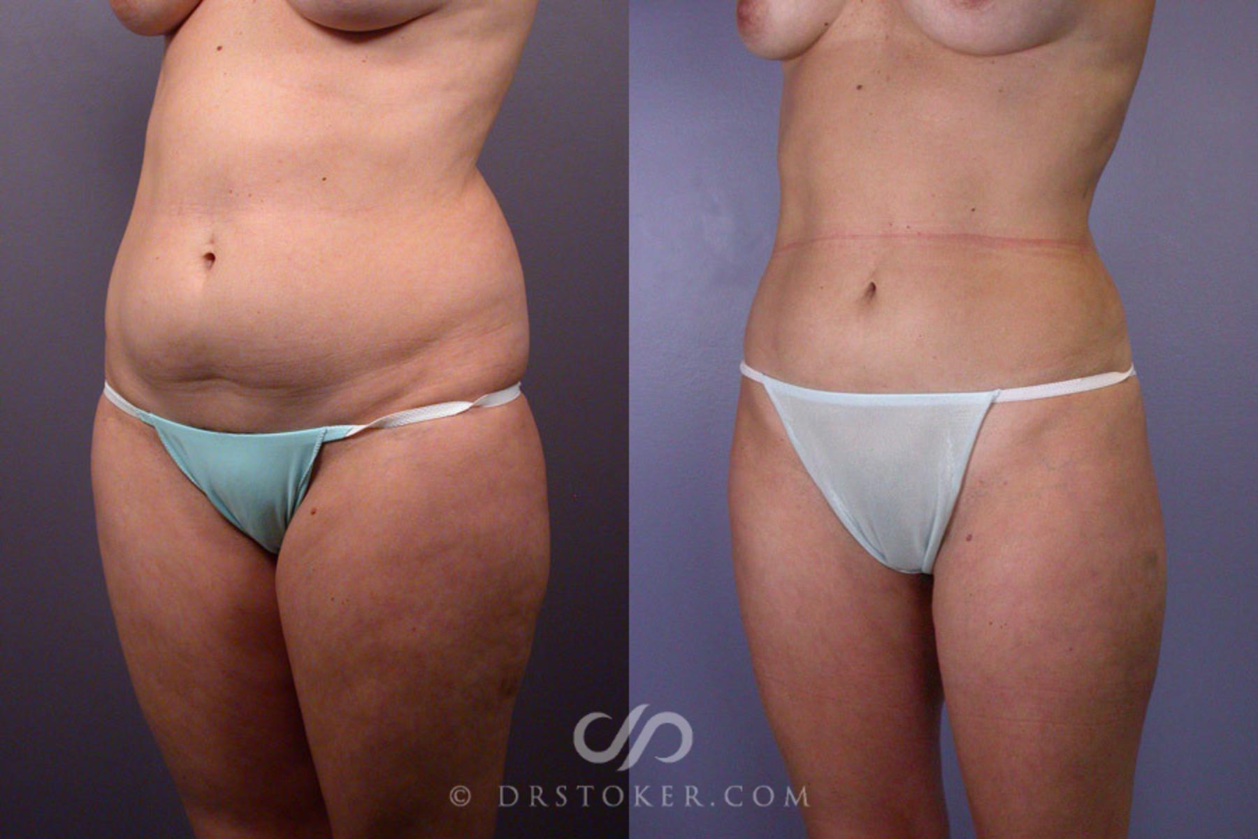 Before & After Liposuction Case 165 View #3 View in Los Angeles, CA