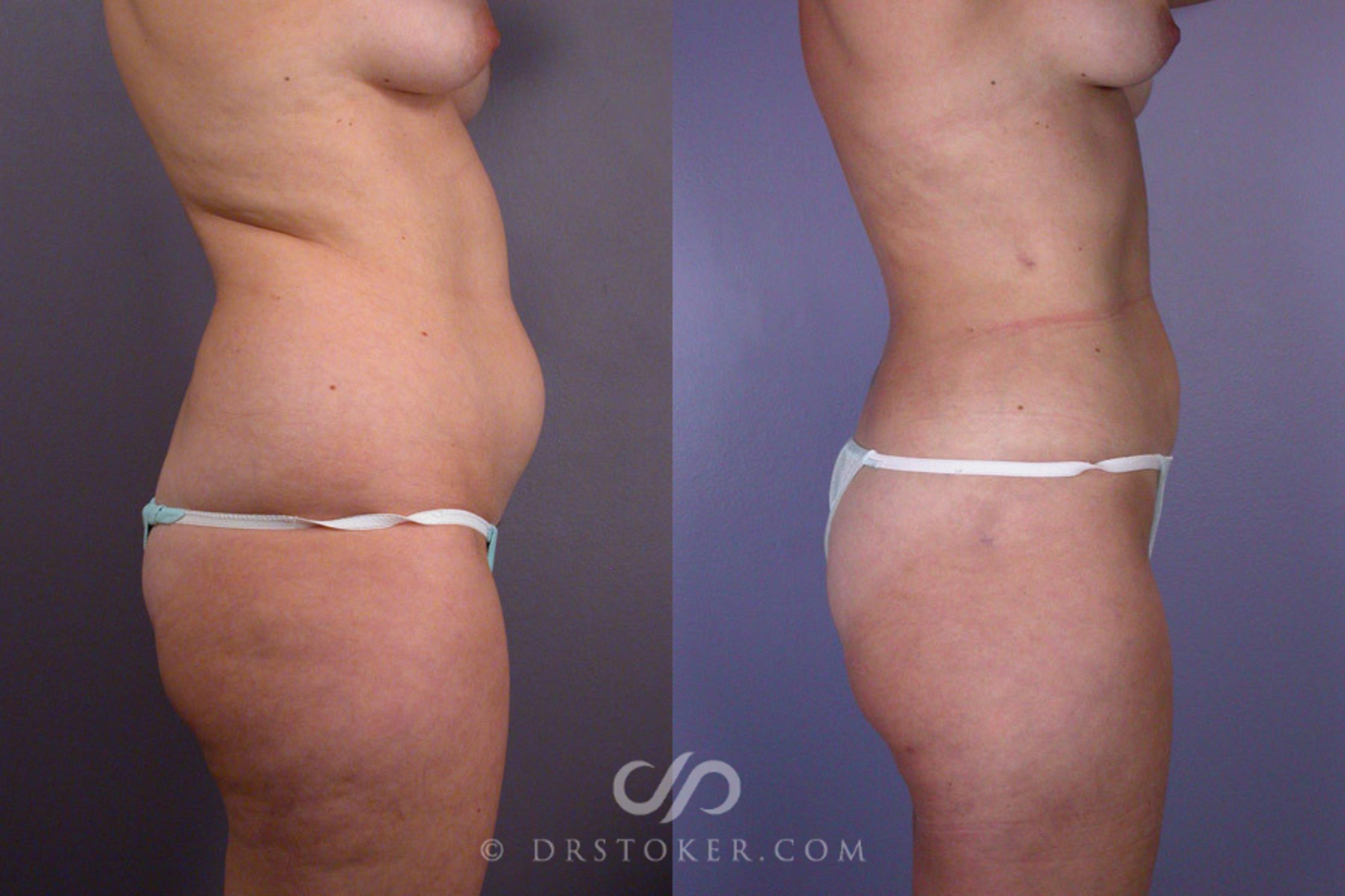 Before & After Liposuction Case 165 View #4 View in Los Angeles, CA