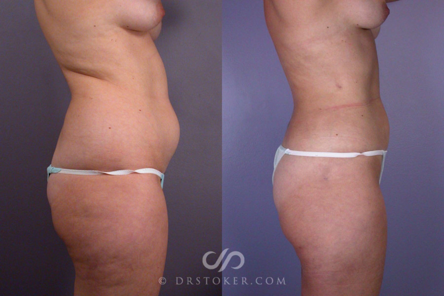 Before & After Liposuction Case 165 View #4 View in Los Angeles, CA