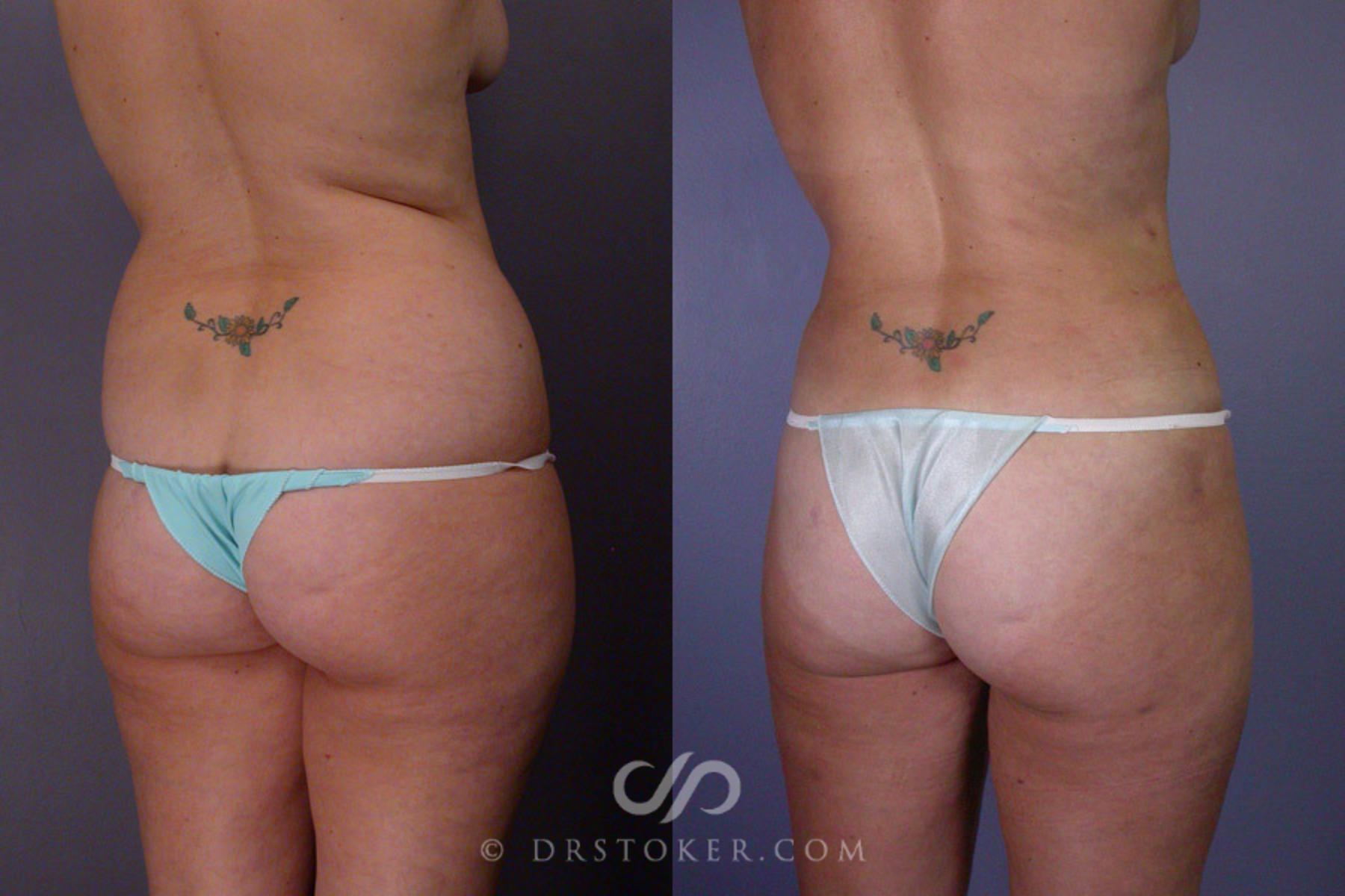 Before & After Liposuction Case 165 View #8 View in Los Angeles, CA