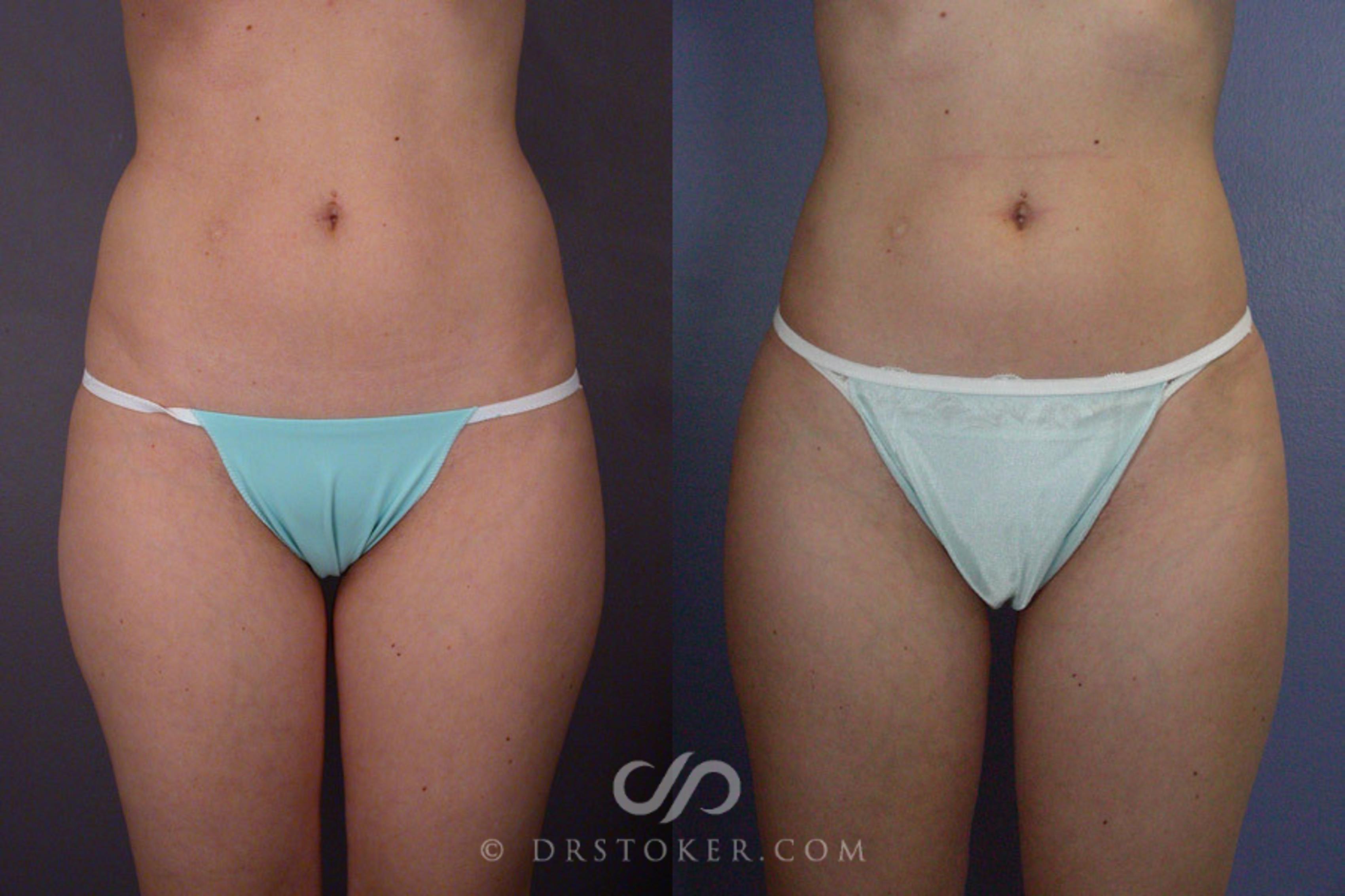 Before & After Liposuction Case 166 View #1 View in Los Angeles, CA