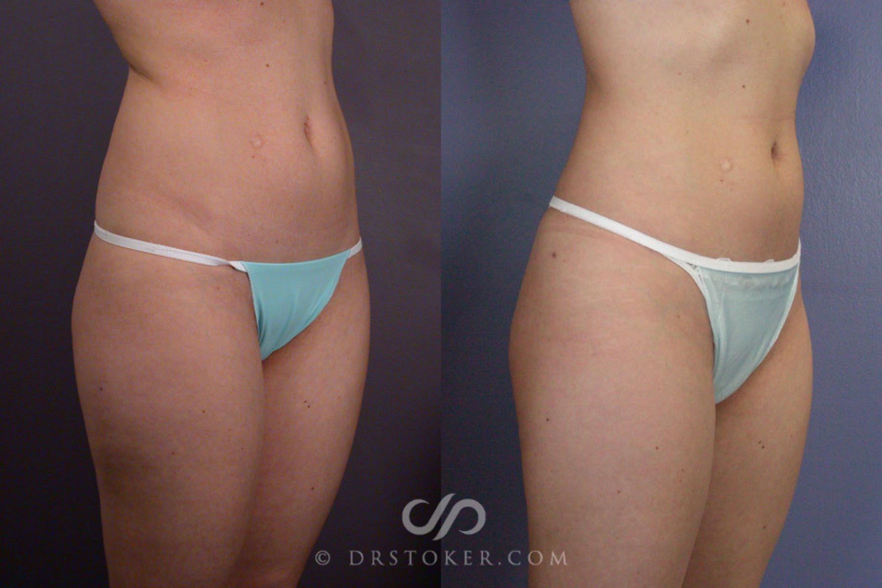 Before & After Liposuction Case 166 View #2 View in Los Angeles, CA