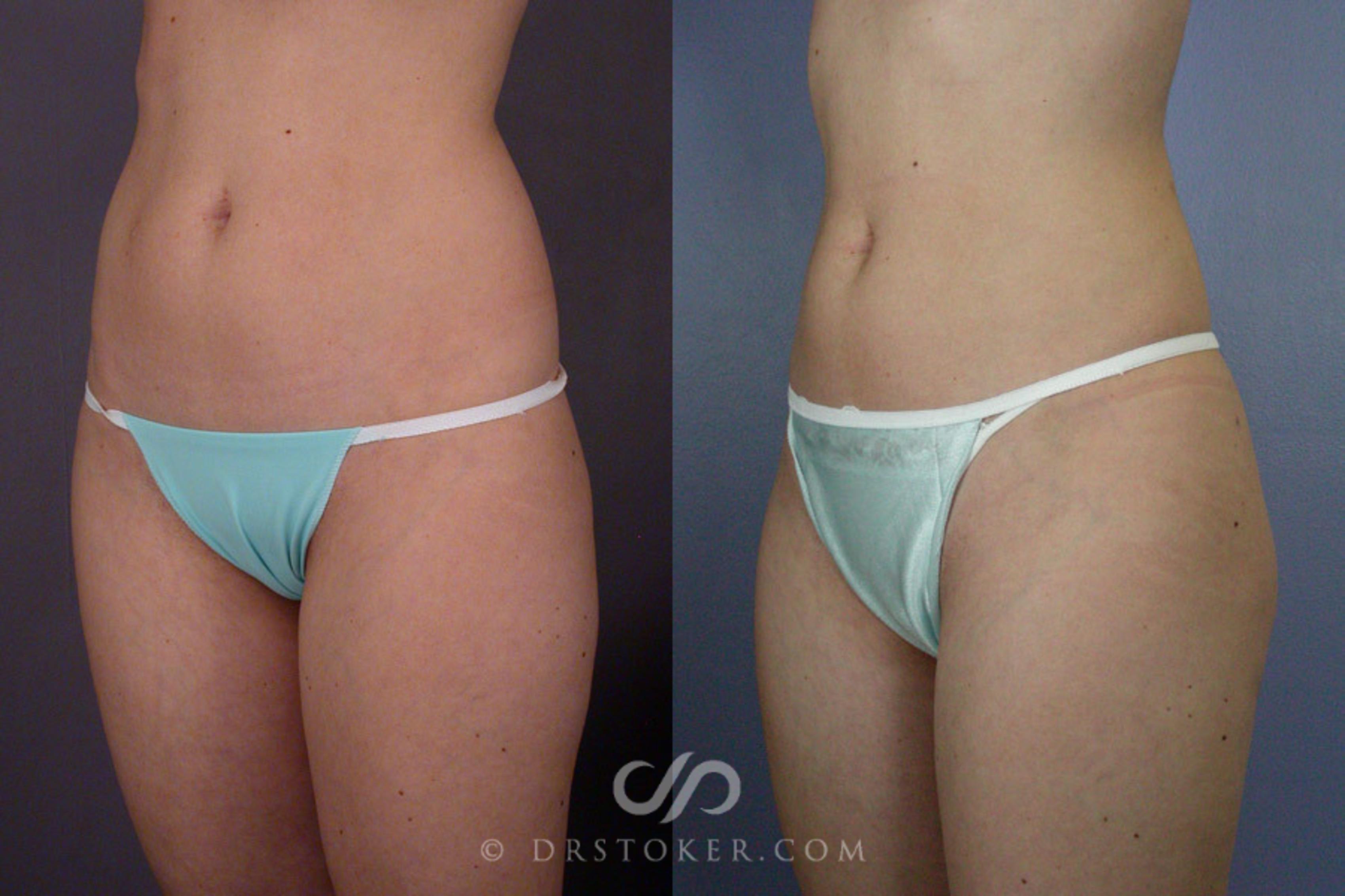 Before & After Liposuction Case 166 View #3 View in Los Angeles, CA