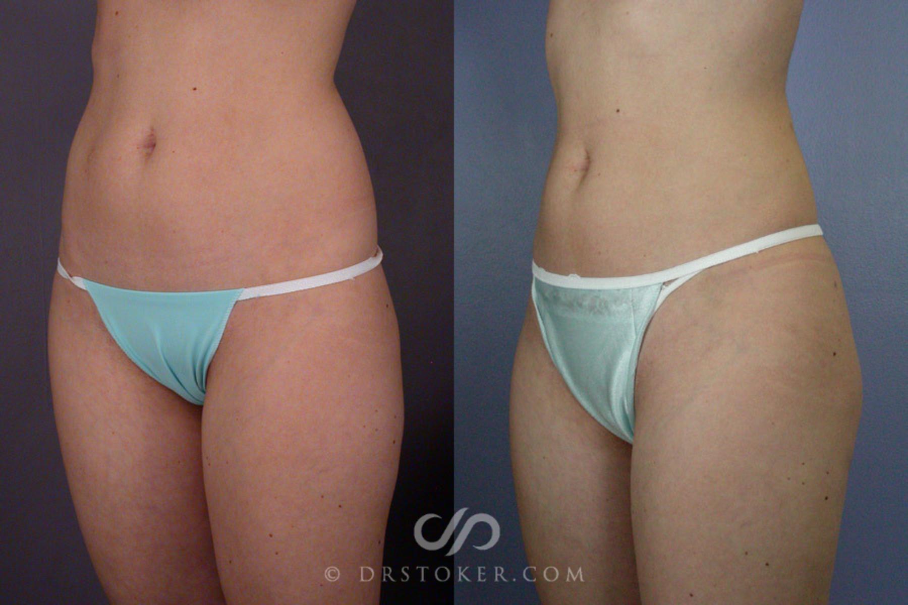 Before & After Liposuction Case 166 View #3 View in Los Angeles, CA