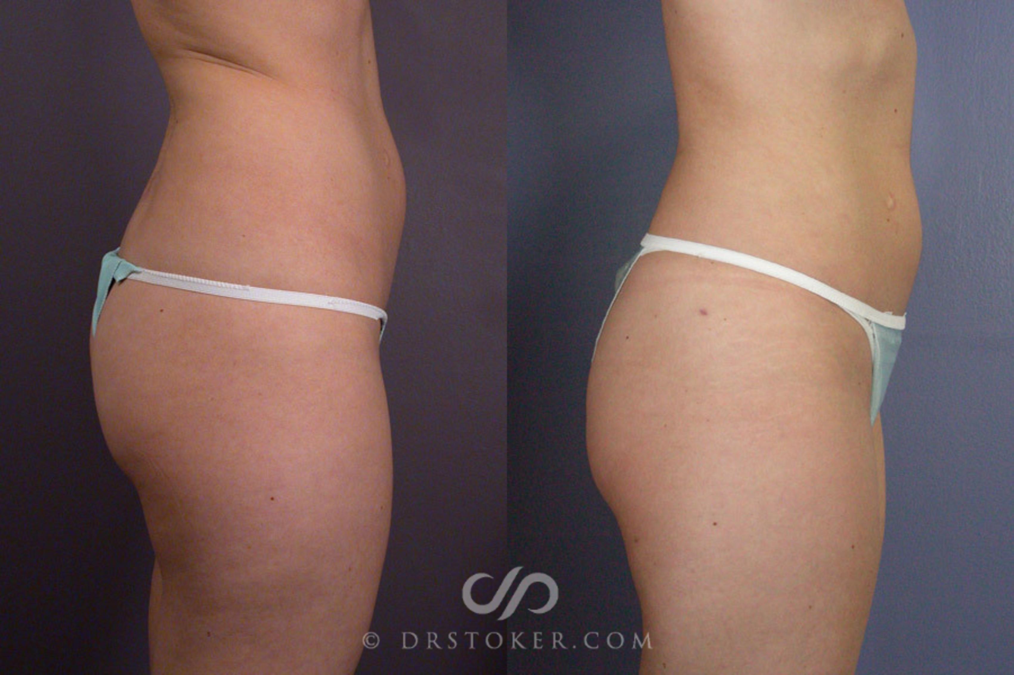 Before & After Liposuction Case 166 View #4 View in Los Angeles, CA