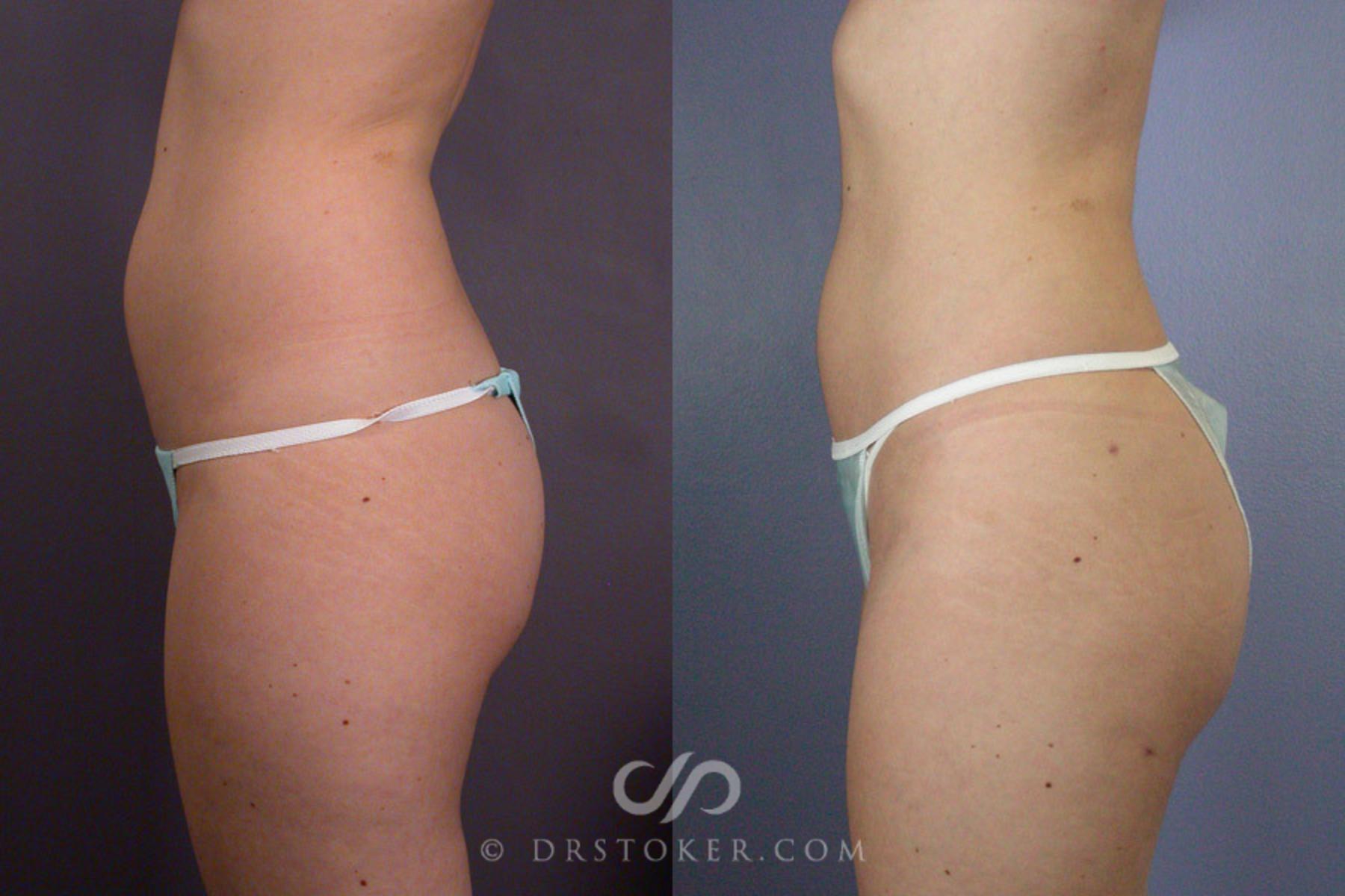 Before & After Liposuction Case 166 View #5 View in Los Angeles, CA