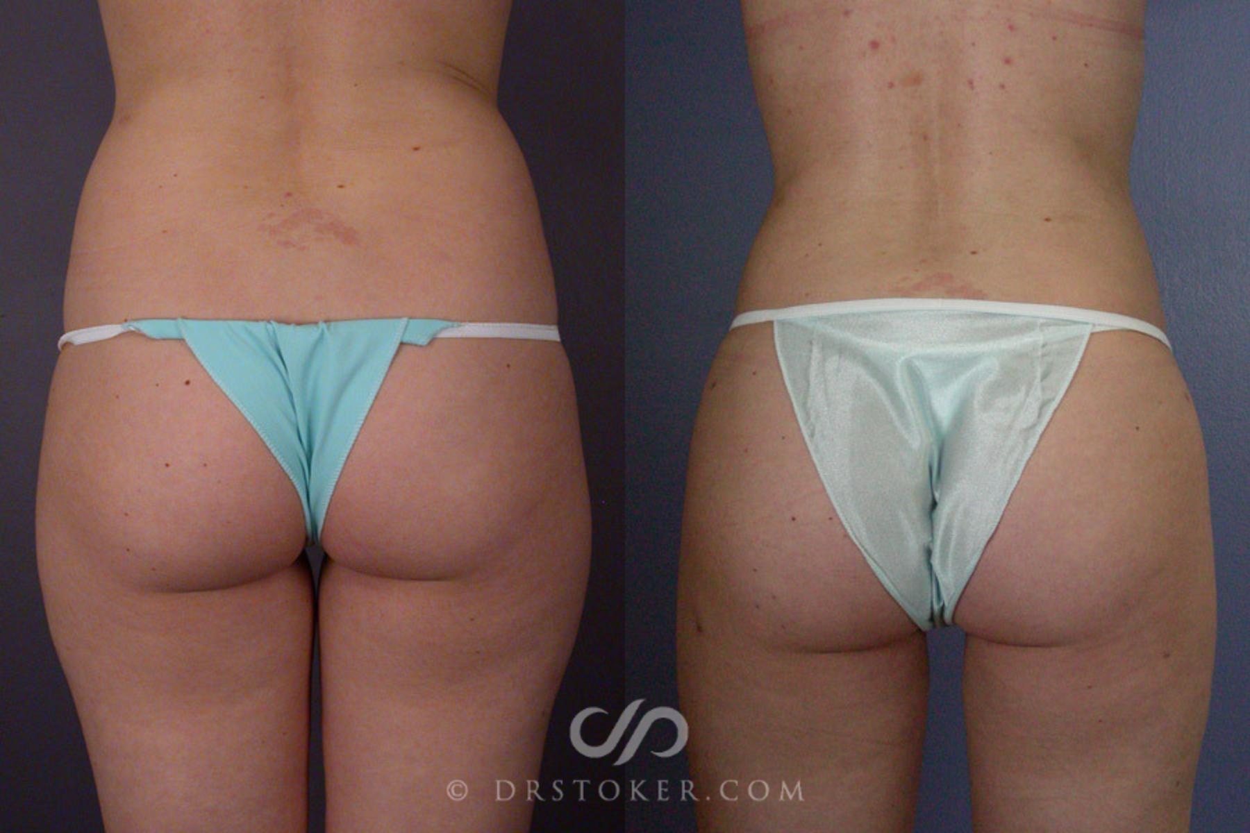 Before & After Liposuction Case 166 View #6 View in Los Angeles, CA
