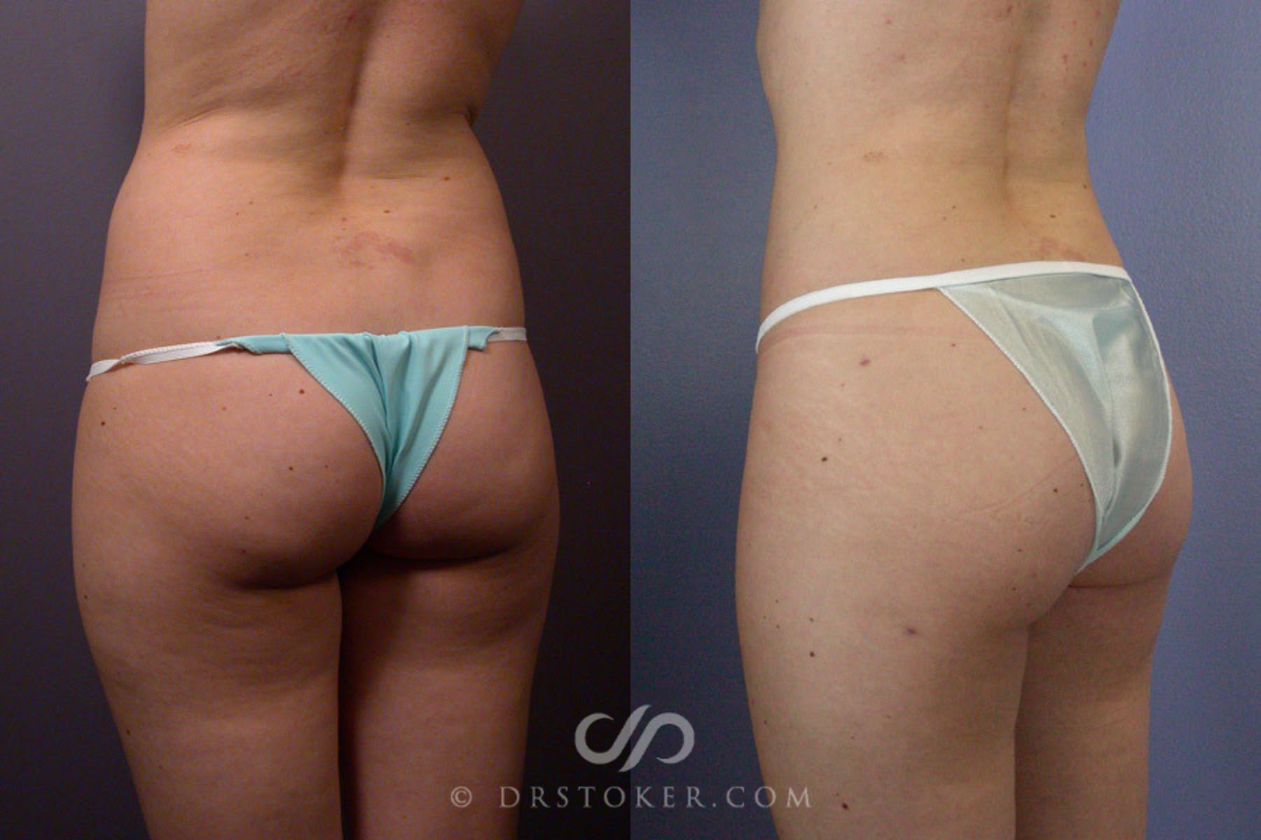 Before & After Liposuction Case 166 View #7 View in Los Angeles, CA